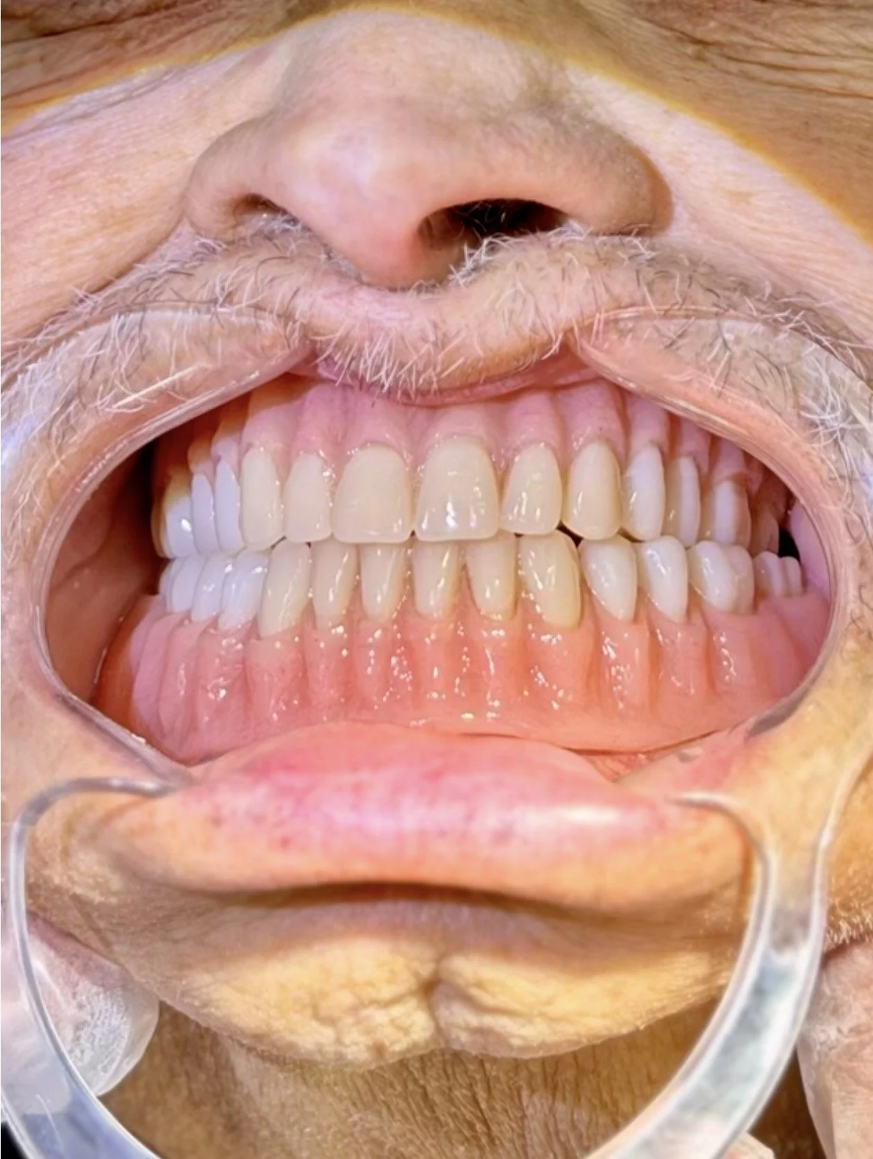 Our Full, Upper, and Lower Dentures are crafted with unsurpassed precision and integrity. They are lifelike, offer a perfect fit, and are built for durability and reliable function.