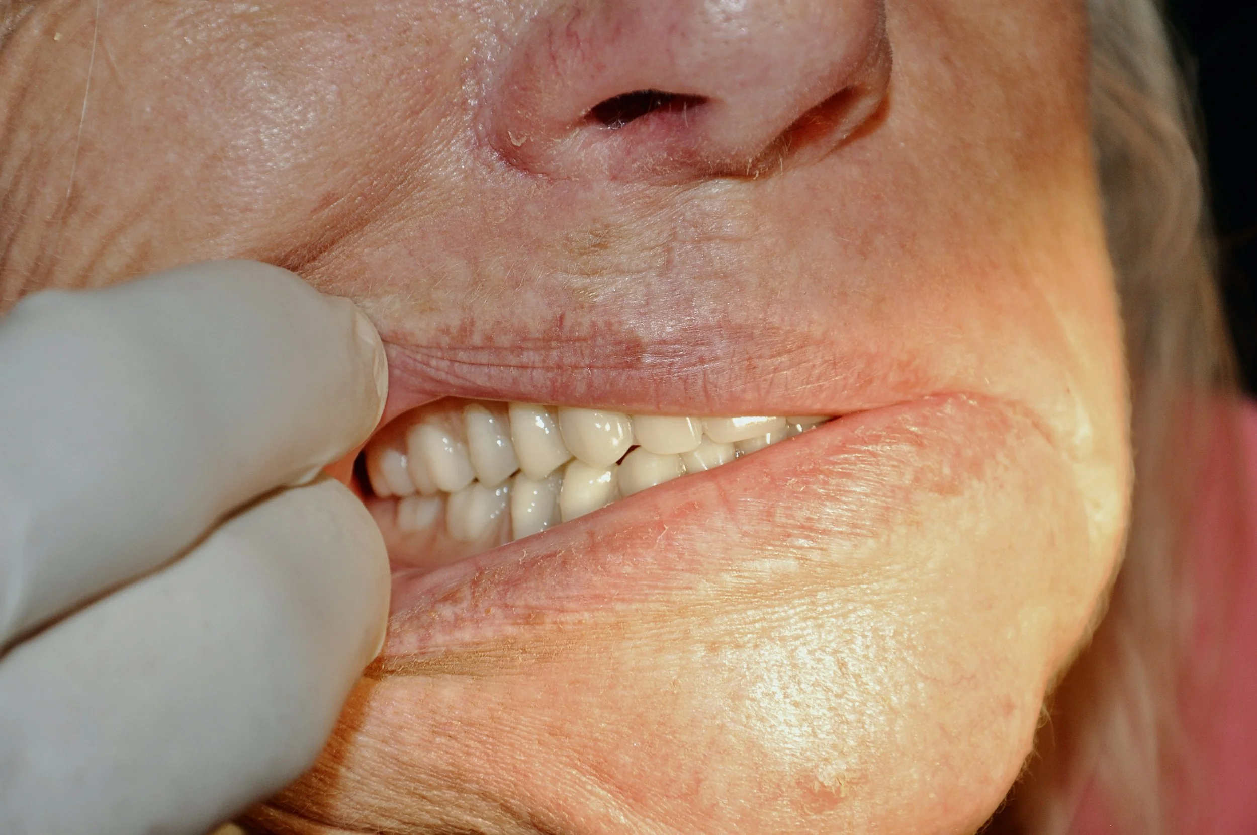 This image provides visual evidence of the high-standard clinical outcomes at SIDISonix Denture Boutique.

It demonstrates the practical application of the QiQit system, showcasing how Dr. Sebastian Riggio ensures proper occlusion (bite) and natural 