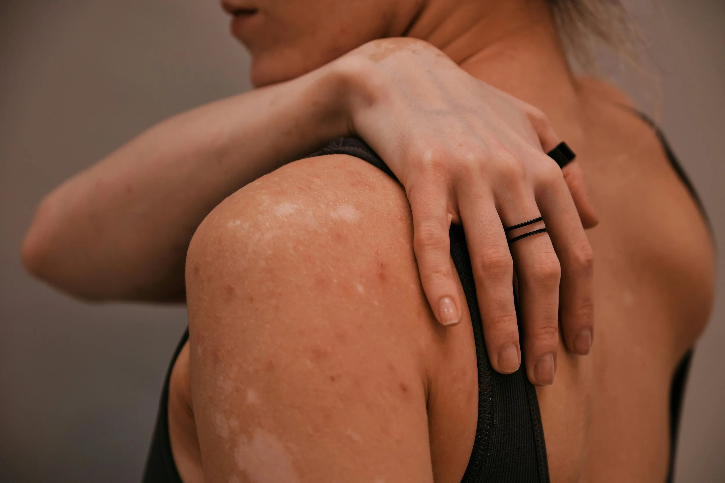 Is It Histamine Intolerance or Something More? What You Need to Know About MCAS