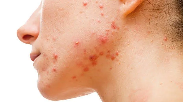 Can What You Eat Affect Acne? What the Research Really Says