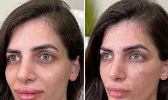 Before and after images of a woman showing improved skin clarity and texture.