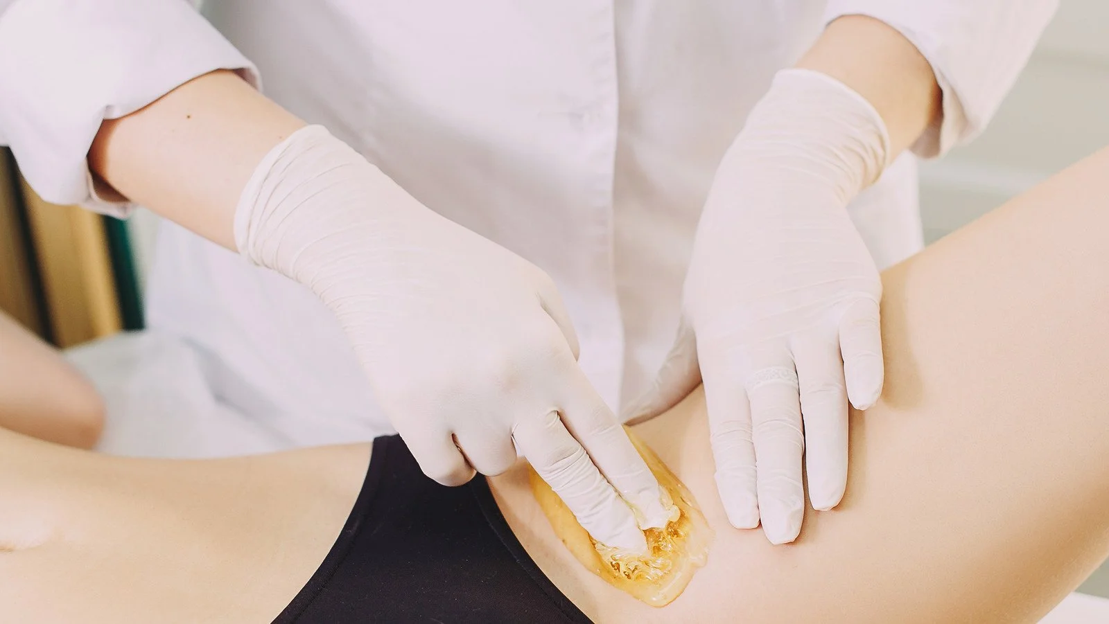 Medical professional wearing gloves applying wax to a patient's leg for hair removal.