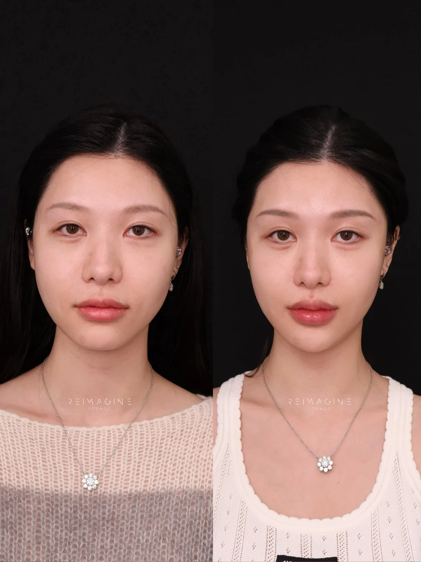 She&rsquo;s young, beautiful&mdash;and this transformation proves that full-face filler doesn&rsquo;t have to be heavy to be effective. 💫

Using a HA filler micro-dosing approach, we refined her facial structure with small, strategic amounts&mdash;e