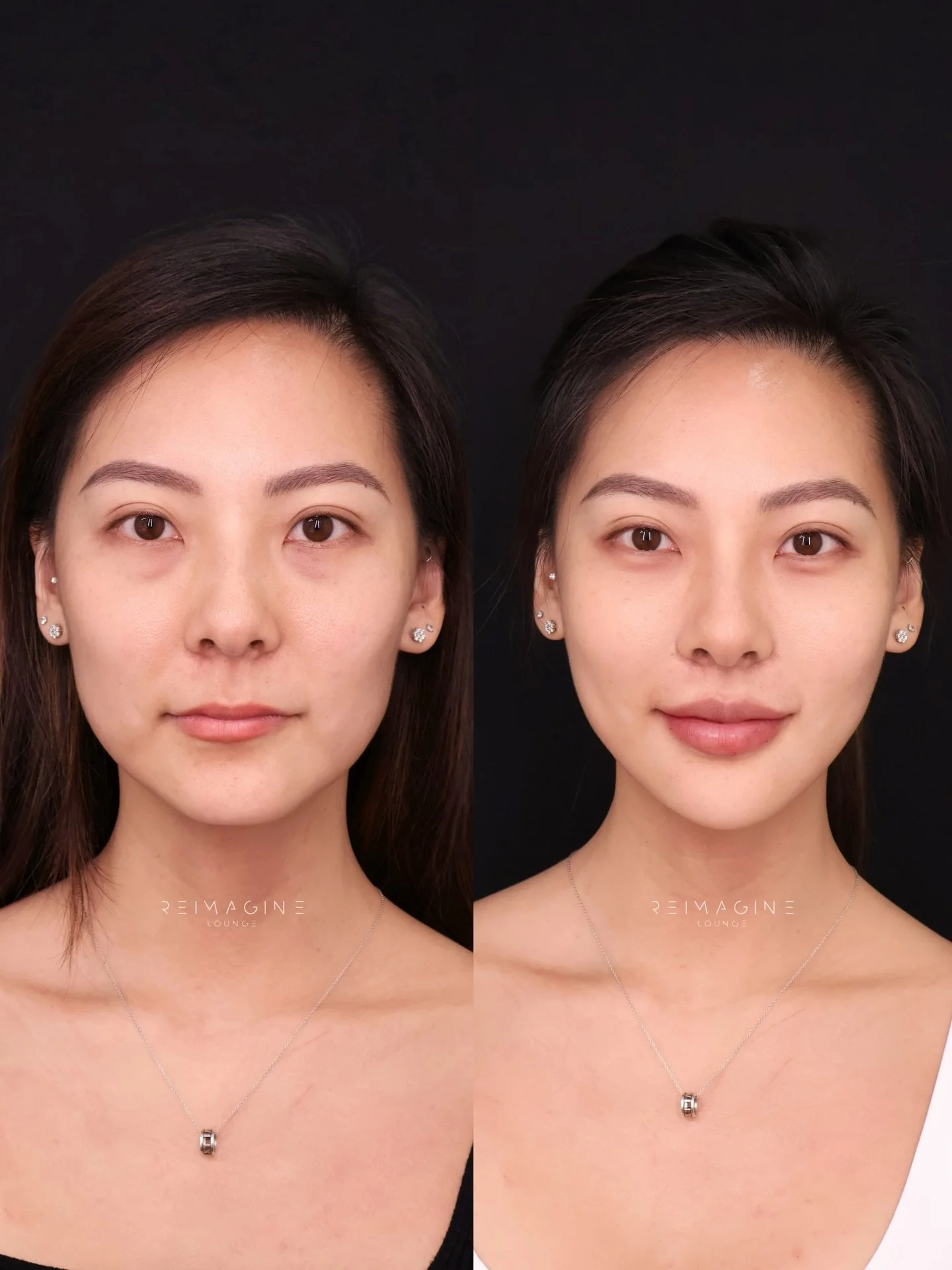 This stunning 30+ y.o. client came in with beautifully strong features&mdash;but like many with a high cheekbone, diamond-shaped face, she was noticing signs of fatigue, tension, and early volume loss.

Through a series of multi-point, low-volume inj