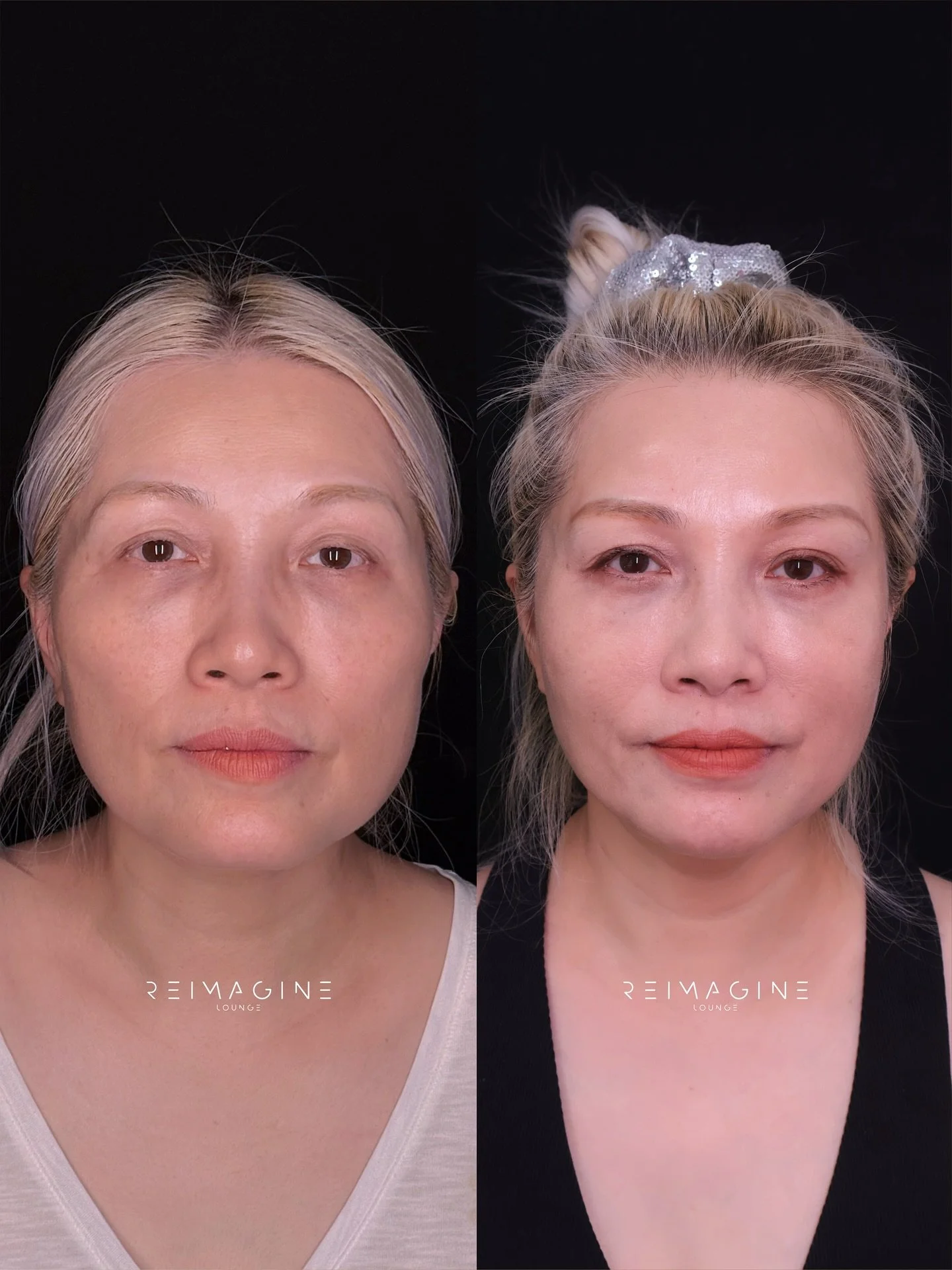 This beautiful client is in her late 50s and have amazing skin&mdash;but like many women in their 50s, she was beginning to notice subtle sagging and bone structure changes that come with time. Her goal? A face that feels youthful, lifted, and full o