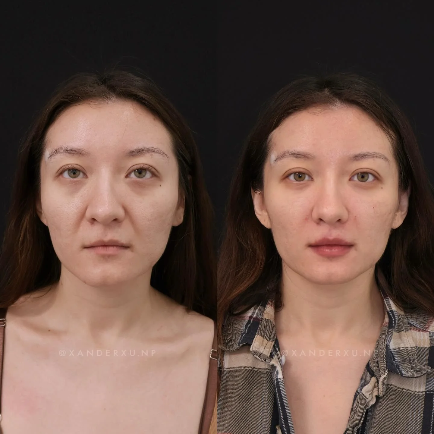 This 28 year old face was already reading tired and more depleted than it needed to.

This was not a reimagination case.
It was a restoration case.

The issue wasn&rsquo;t just the under-eyes.
It was interruption of the maxillary flush, loss of suppo