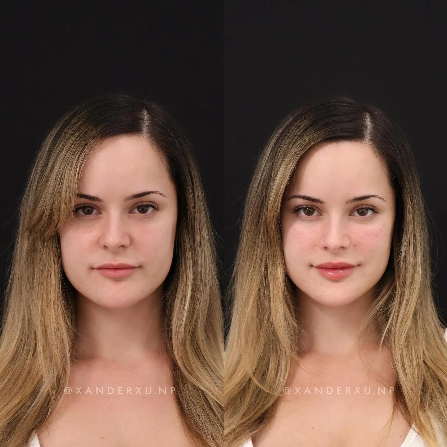 Structural refinement, not volume.

Two syringes placed strategically to support the midface, under-eyes, and lips&mdash;so everything reads more balanced and complete.

#facialbalancing 
#facialharmonization 
#subtleaesthetics 
#naturalenhancement 
