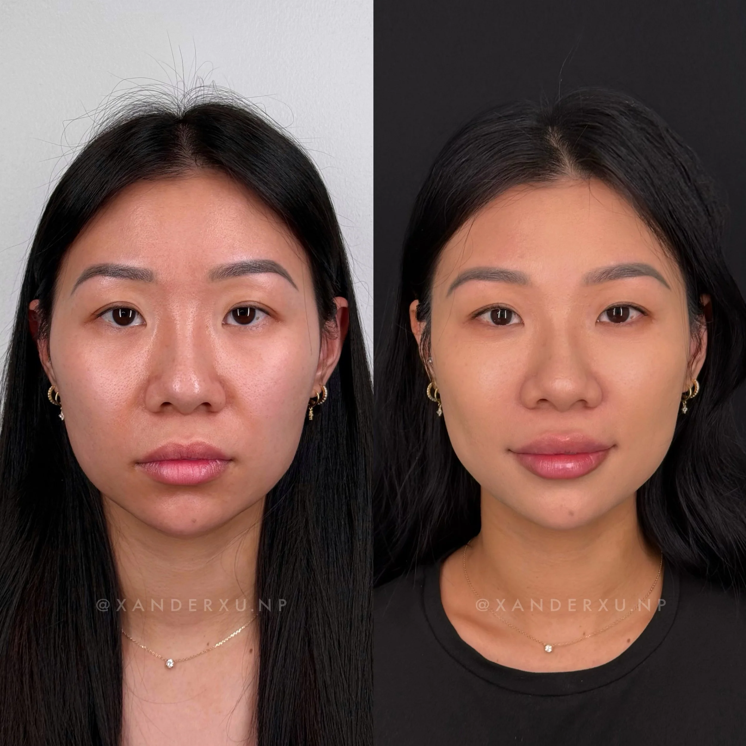 Not a different face. A better-supported face.

This is subtle full-face refinement &mdash; softening shadows, supporting structure, and restoring balance without changing who she is.

The face looks brighter, smoother, and more lifted &mdash; but st