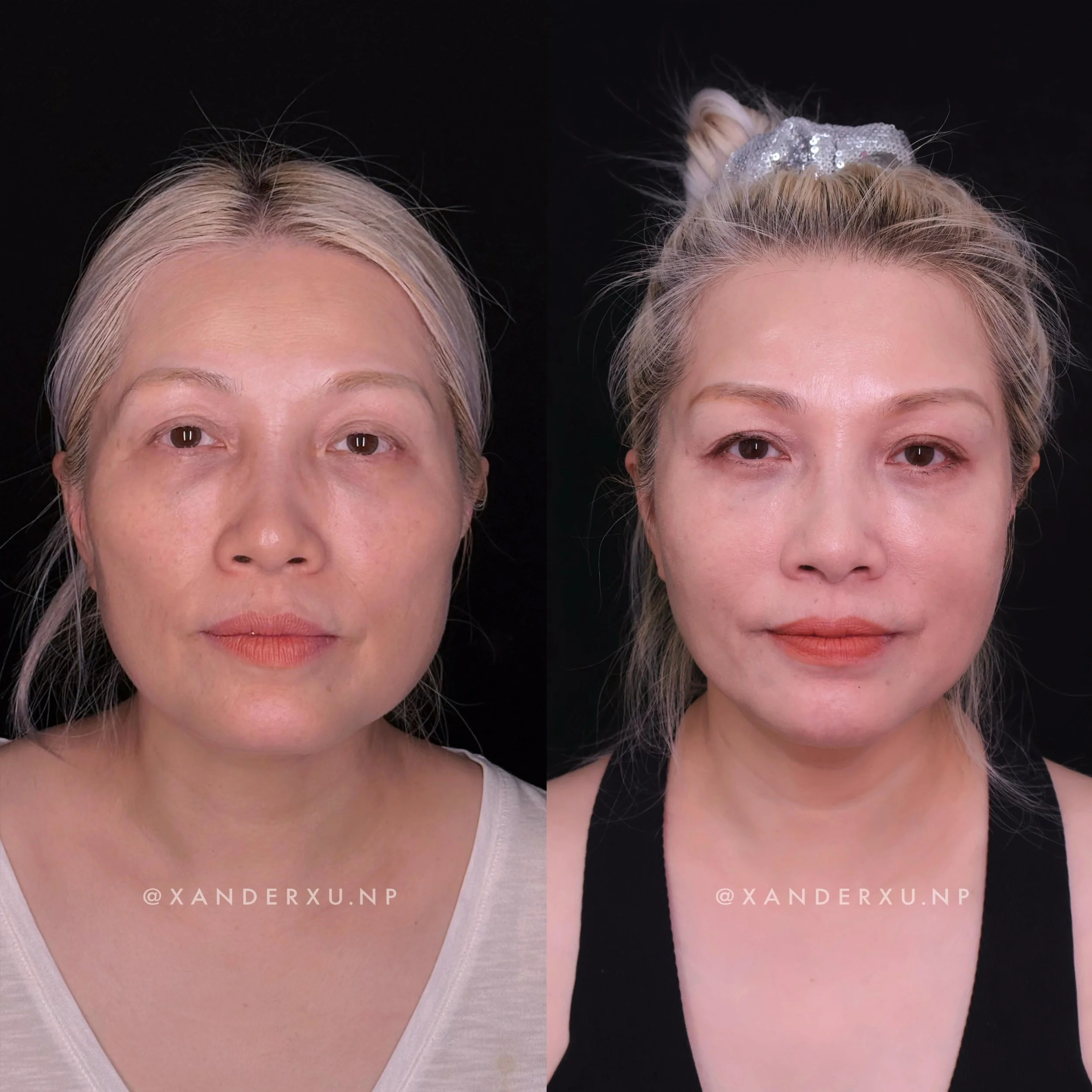 Many women think they need a facelift. They may just need support.

50 years old.
No surgery.
No dramatic changes.

Just restoring support where time gradually takes it away.

Notice the temples.
Notice the midface.
Notice the area around the mouth.
