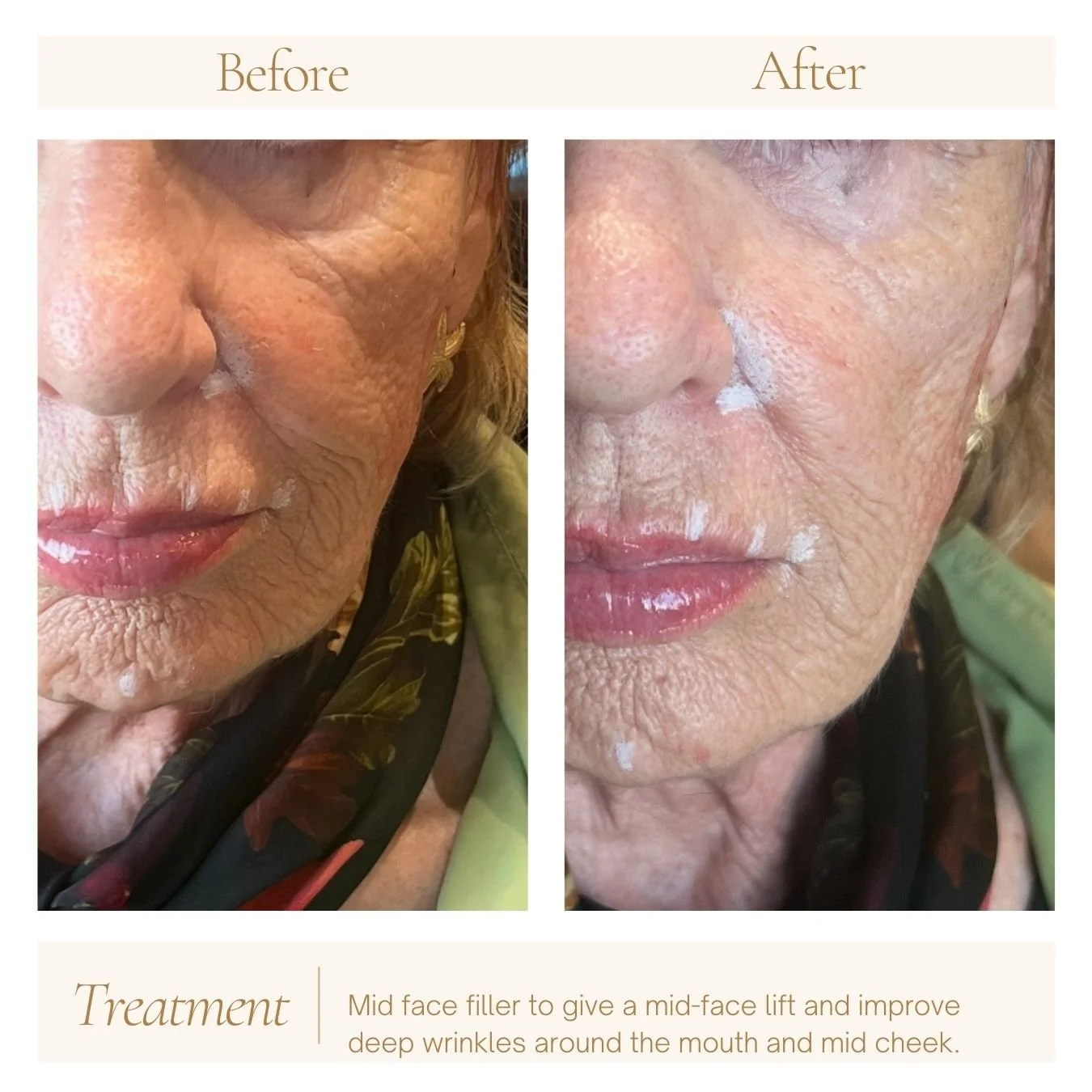 Mid cheek filler to improve volume loss in the midface. 