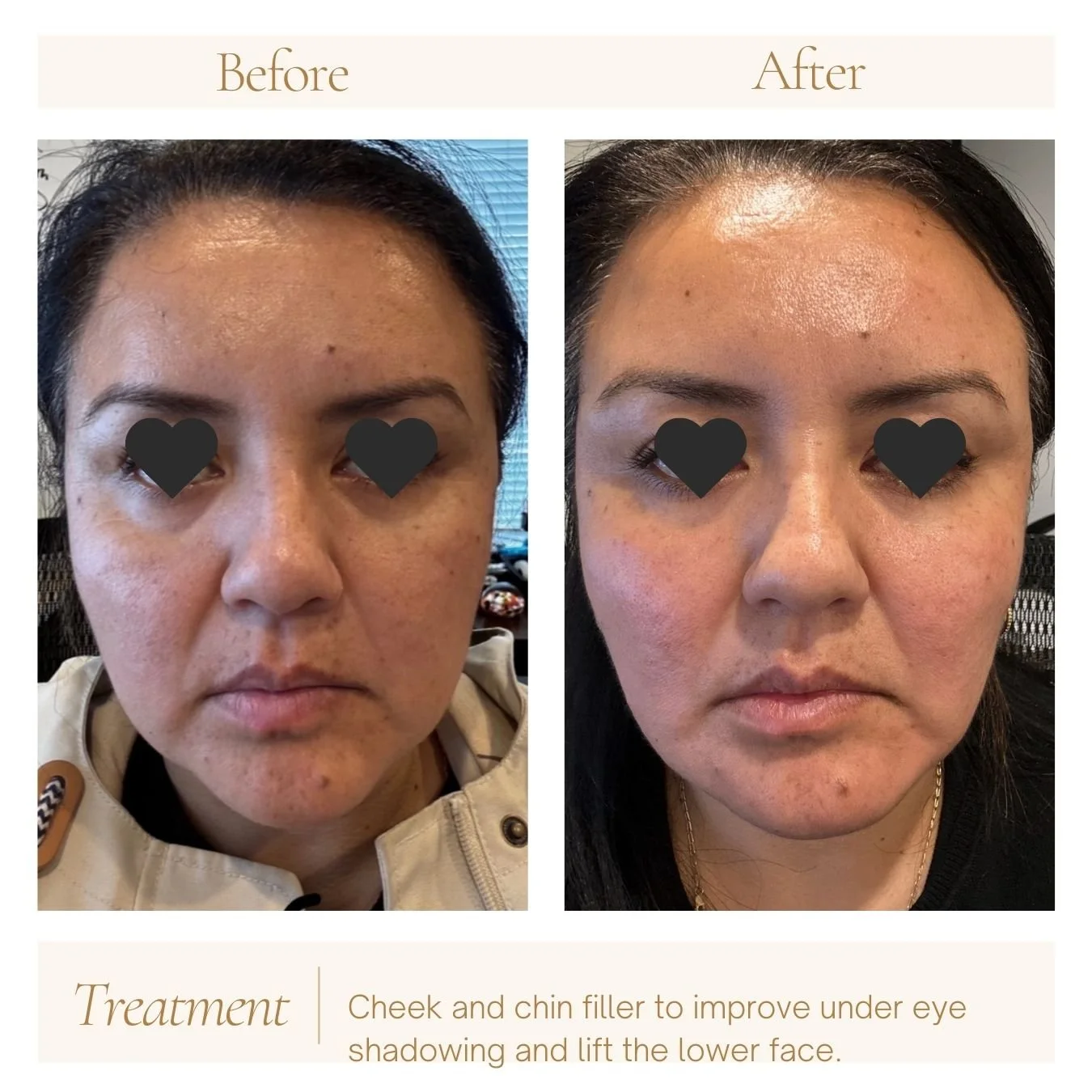 Cheek filler and chin filler to improve under eye area and improve the contour of the jawline. 