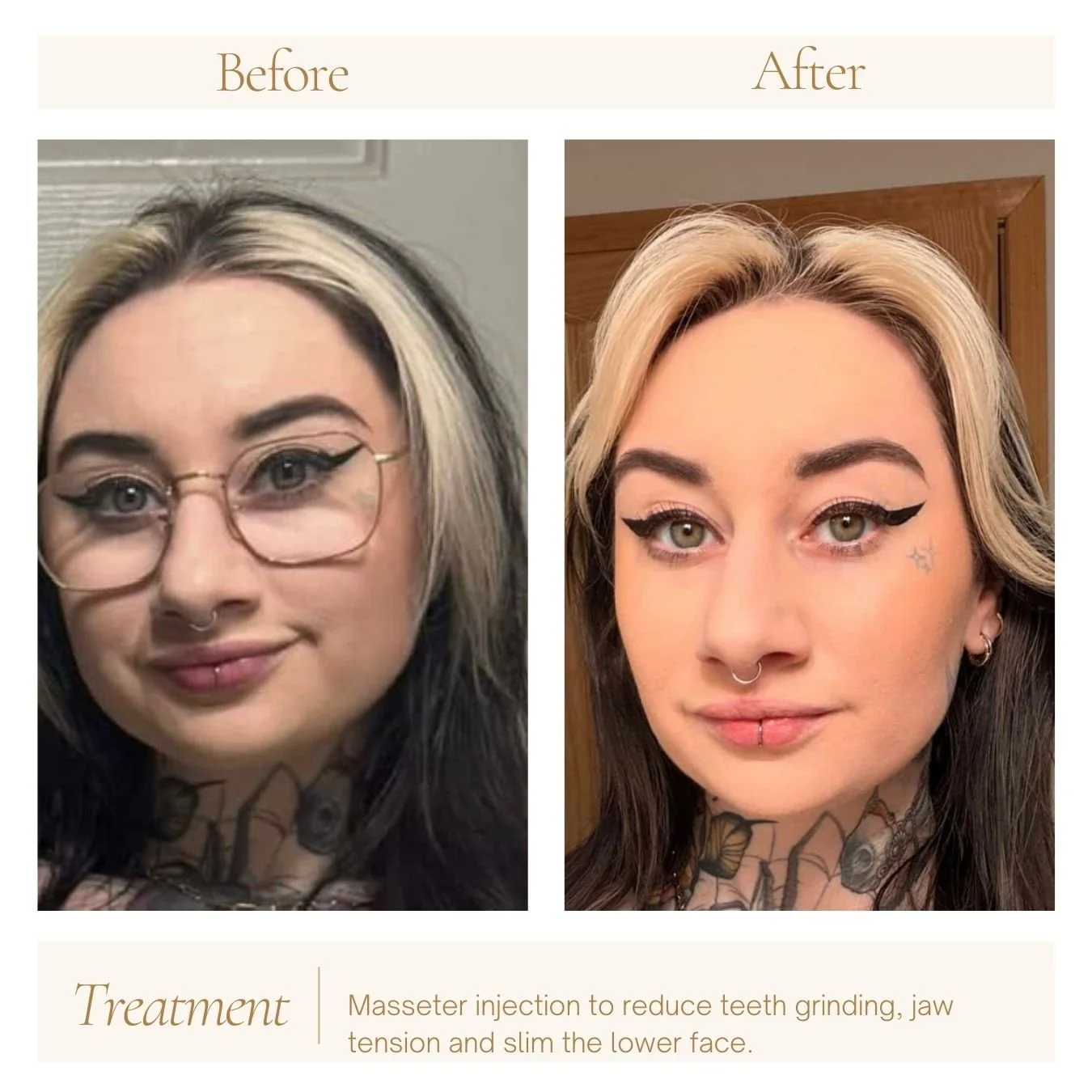 Masseter injection with neurotoxin to treat teeth grinding, jaw tension and to slim lower face. 