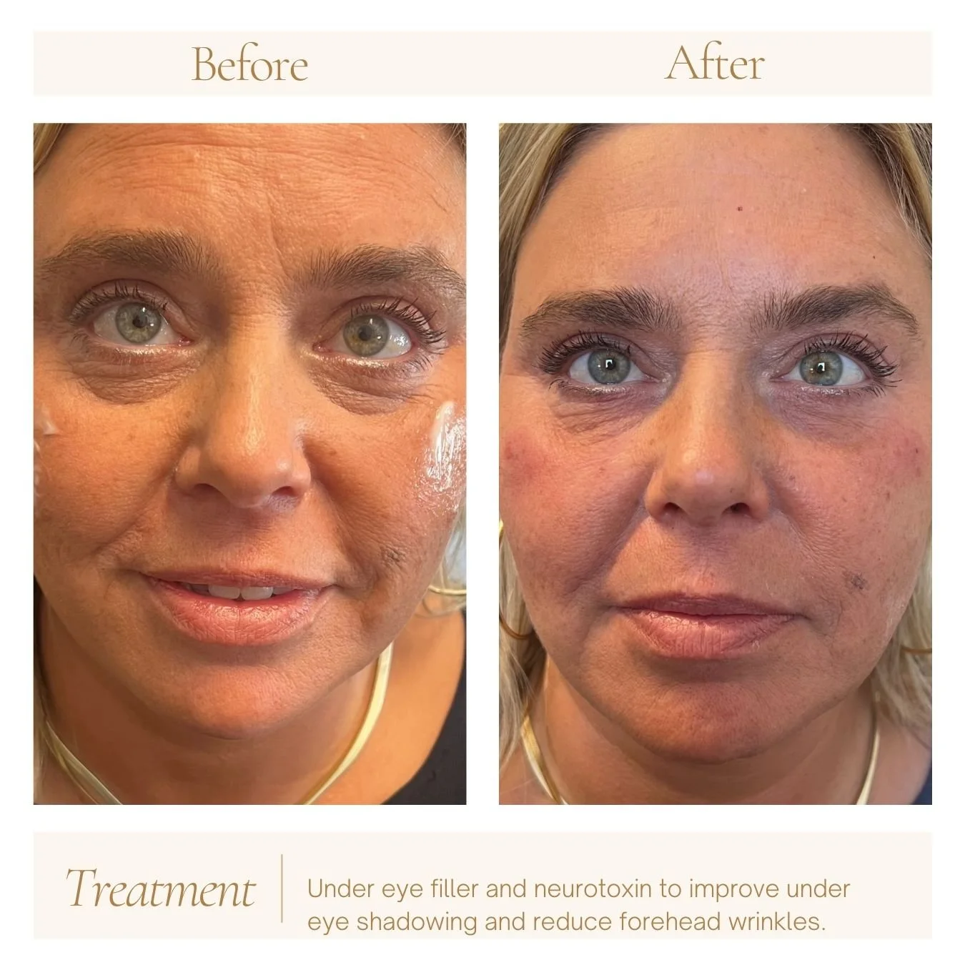 Under eye filler and neurotoxin treatment to treat forehead wrinkles and under eye volume loss. 