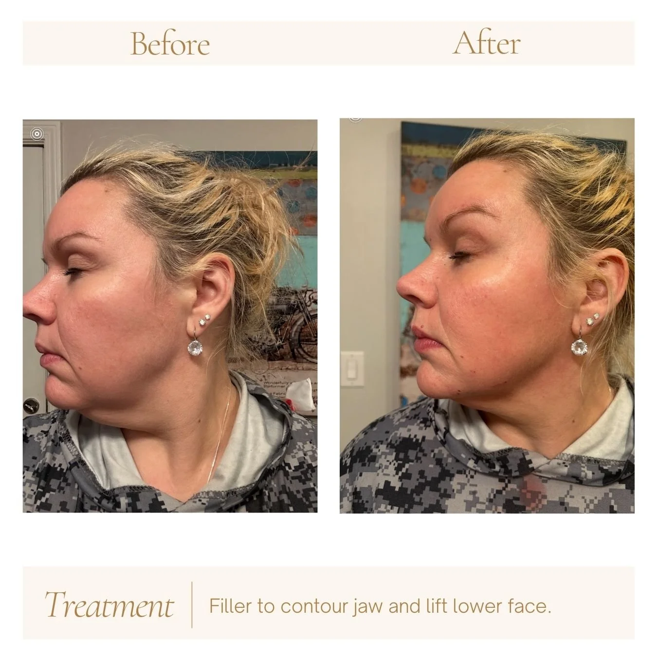Jawline contouring and lower face lift with filler. 