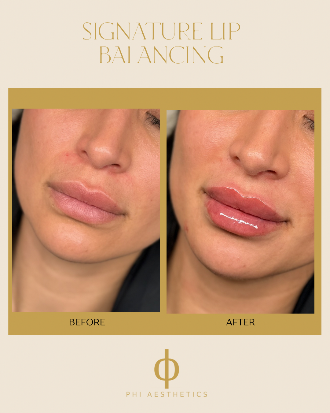 Lip Enhancement: Your lips, Just Better!