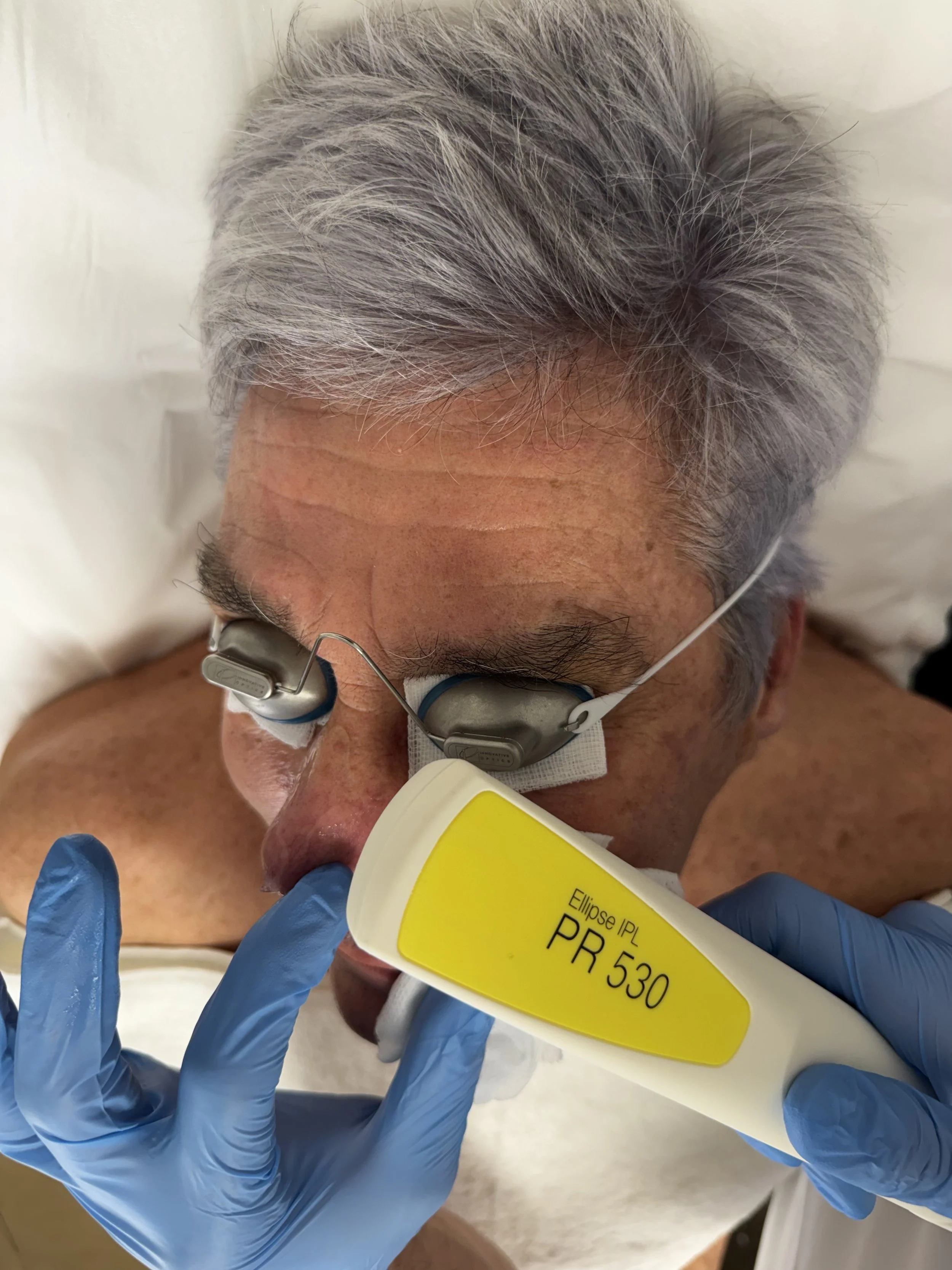 LASER IPL Nordlys PR530 - Traitement Lesions Vasculaires Visage