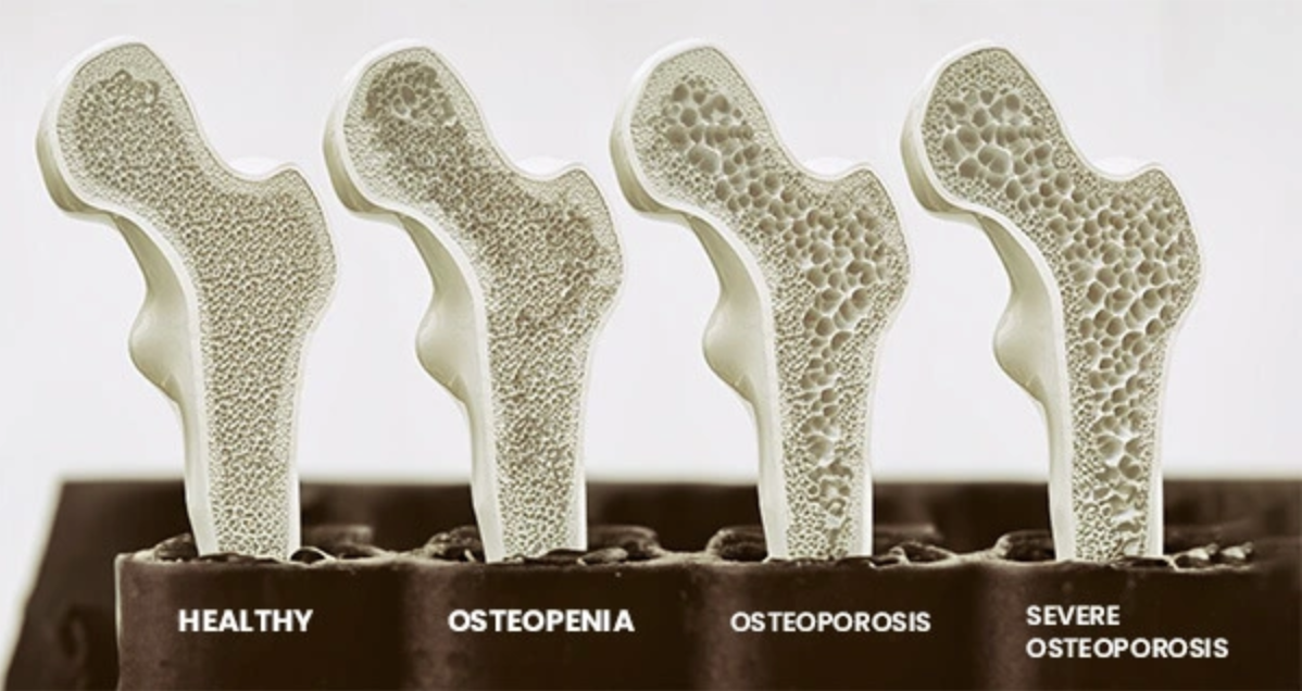 Safeguarding your skeleton: Preventing osteopenia and osteoporosis through nutrition, resistance training, and lifelong habits