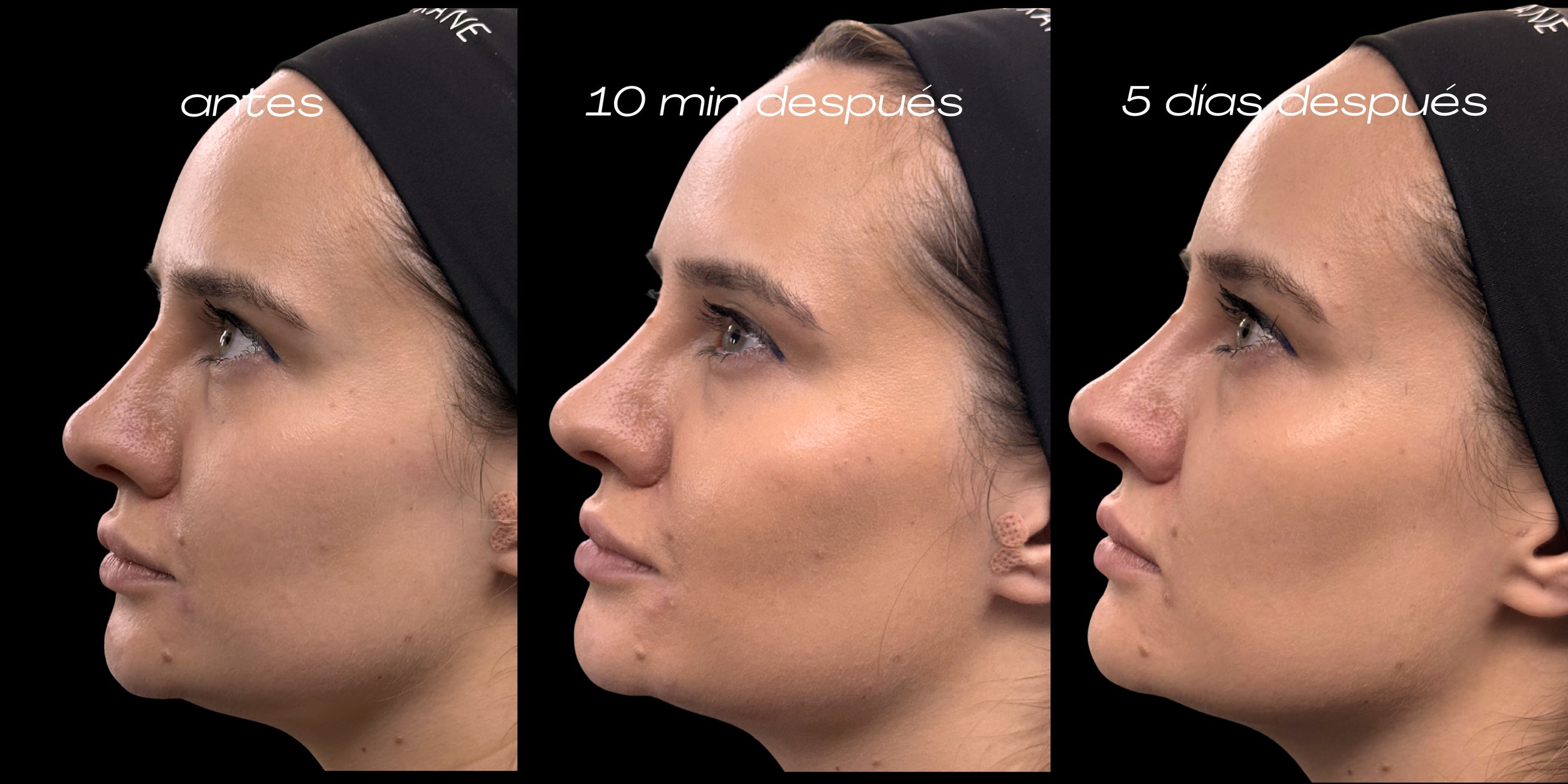 TEOXANE® BabyGLOW