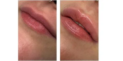 AUMENTO DE LABIOS BARCELONA