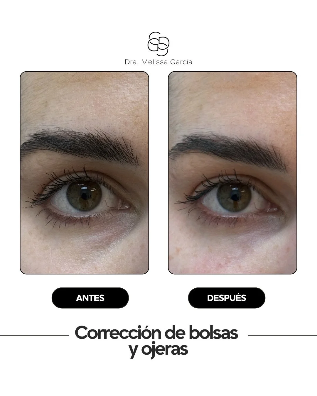 La zona de la mirada es una de las primeras en reflejar cansancio, ojeras y bolsas&hellip; incluso cuando no lo sientes.

La correcci&oacute;n de ojeras y bolsas con &aacute;cido hialur&oacute;nico permite mejorar el hundimiento del surco lagrimal, s
