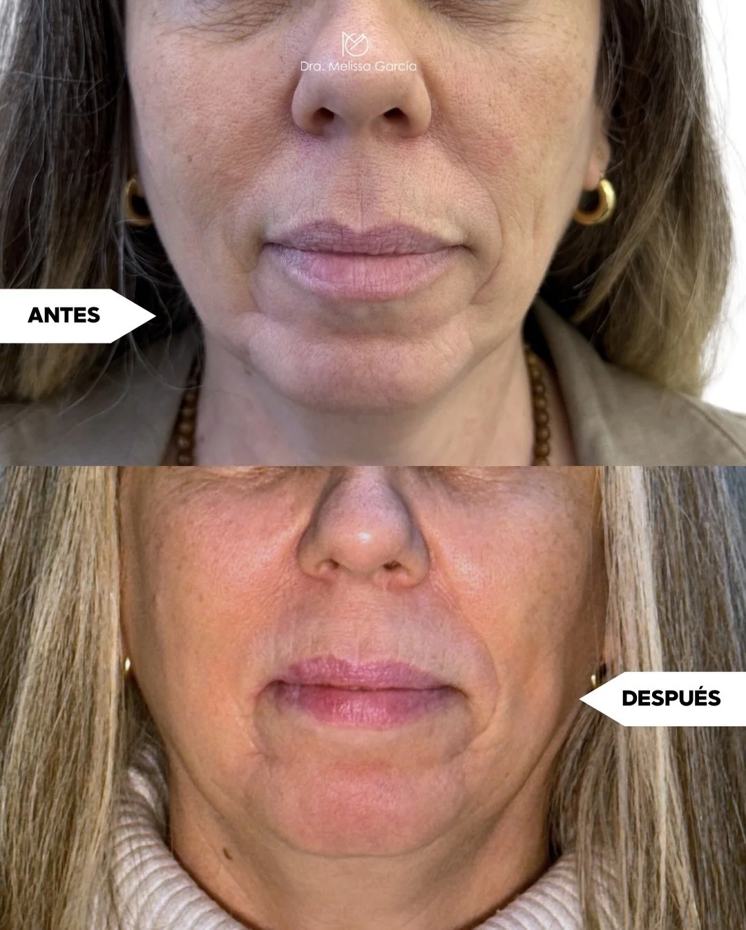 Estimular el col&aacute;geno es una de las claves del rejuvenecimiento natural.

Sculptra es un bioestimulador que ayuda a activar la producci&oacute;n natural de col&aacute;geno, mejorando progresivamente:

✨ firmeza de la piel
✨ volumen facial
✨ te