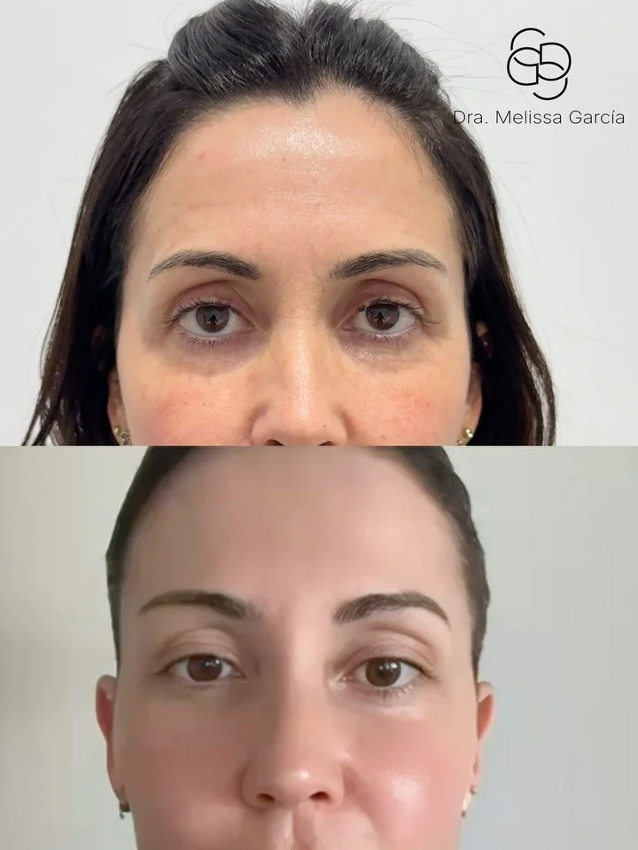 Elimina arrugas con neuromoduladores 
Eliminar arrugas con neuromoduladores

Elimina arrugas de la frente, entrecejo y patas de gallo con neuromoduladores. Suaviza las l&iacute;neas de expresi&oacute;n sin perder naturalidad.

Resultados visibles en 