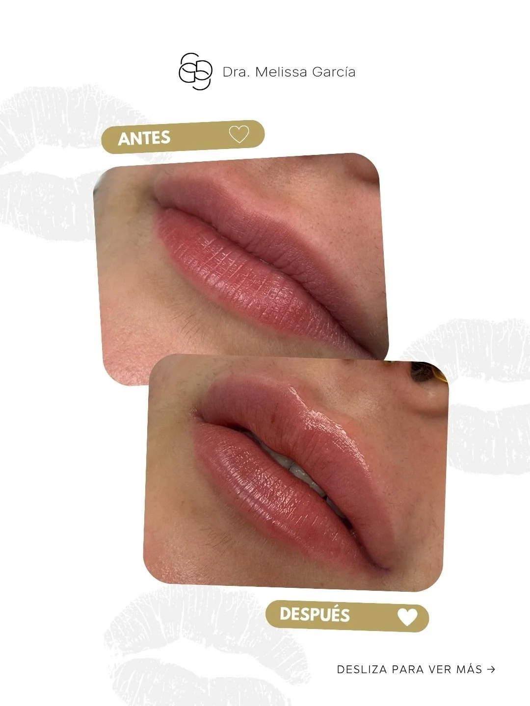 💋La diferencia entre unos labios artificiales y unos labios arm&oacute;nicos est&aacute; en la t&eacute;cnica, el conocimiento anat&oacute;mico y la calidad del producto utilizado. Por eso es fundamental trabajar con &aacute;cido hialur&oacute;nico 