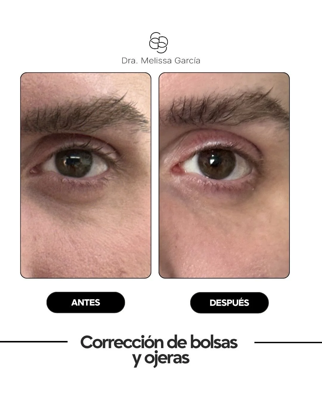 Tratamiento de ojeras con &aacute;cido hialur&oacute;nico en Barcelona ✨

Una mirada cansada no siempre significa falta de descanso. Con el paso del tiempo, la p&eacute;rdida de soporte estructural y volumen en la zona periocular puede hacer que las 