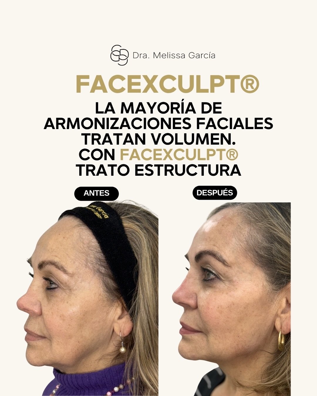 En este caso no solo conseguimos una transformaci&oacute;n global del rostro.

Tambi&eacute;n logramos refinar visualmente sus proporciones y potenciar ese toque elegante y femenino que ella llevaba a&ntilde;os intentando conseguir con su nariz, incl