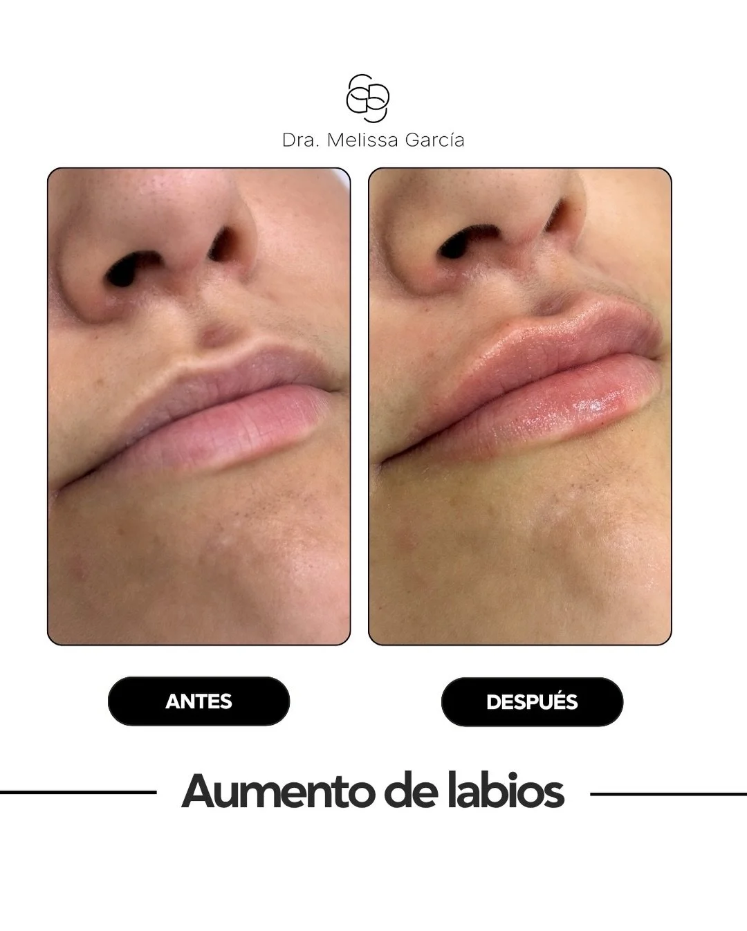 Aumento de labios en Barcelona
💋 No se trata solo de volumen. Se trata de equilibrio, proporci&oacute;n y naturalidad.

El aumento de labios con &aacute;cido hialur&oacute;nico permite:
&bull; Definir el contorno labial
&bull; Mejorar la hidrataci&o