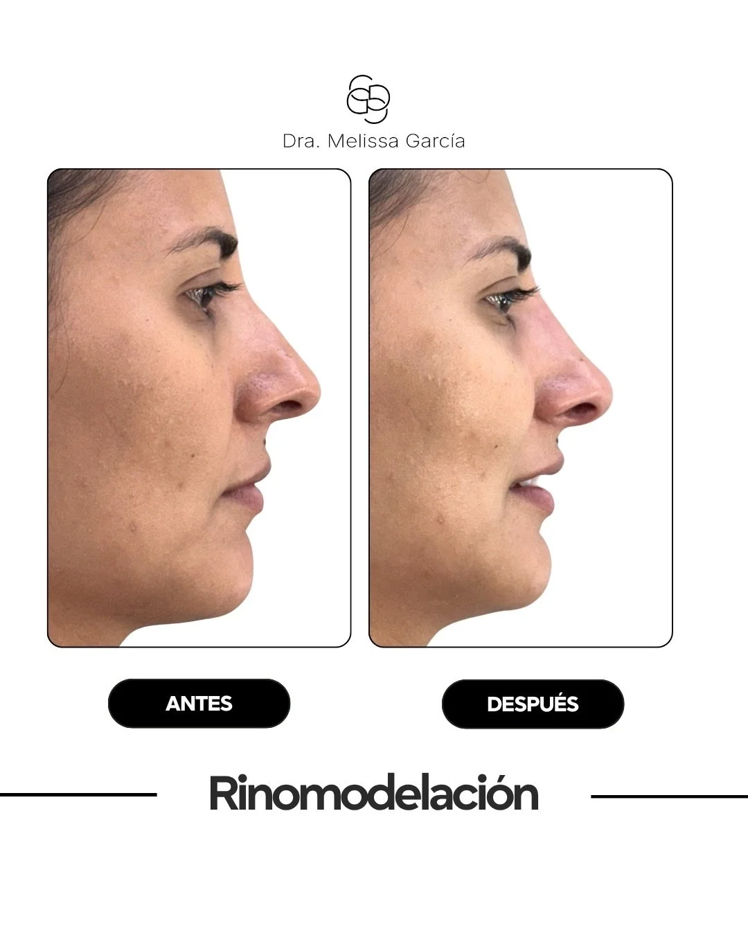&iquest;Sab&iacute;as que puedes transformar tu nariz sin cirug&iacute;a? 👃✨
La rinomodelaci&oacute;n con &aacute;cido hialur&oacute;nico es la t&eacute;cnica no invasiva que equilibra y armoniza tu perfil en minutos.
✅ Sin bistur&iacute;
✅ Sin anes