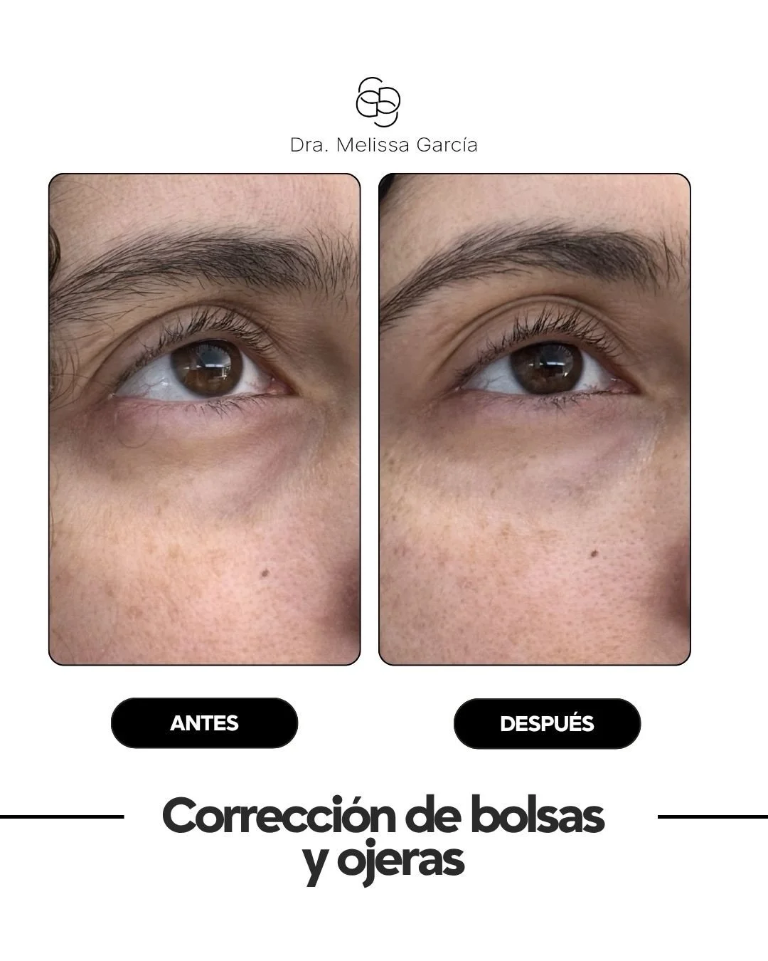 Ojeras hundidas, cansancio facial o bolsas bajo los ojos? 👁️✨

Este antes y despu&eacute;s de correcci&oacute;n de ojeras y bolsas muestra c&oacute;mo un tratamiento bien indicado puede mejorar el aspecto de mirada cansada, recuperar frescura y reju