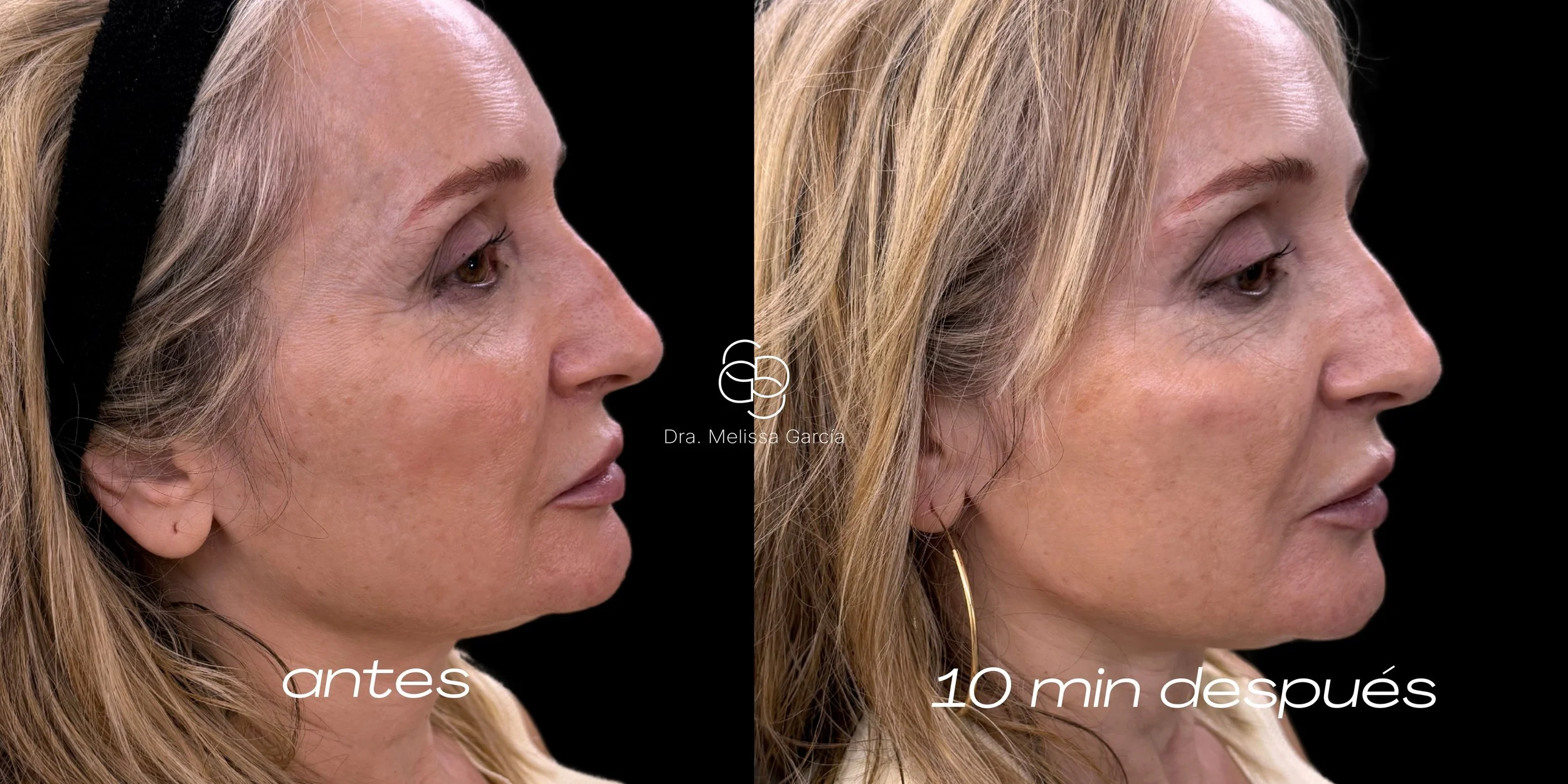 tratamiento glow barcelona