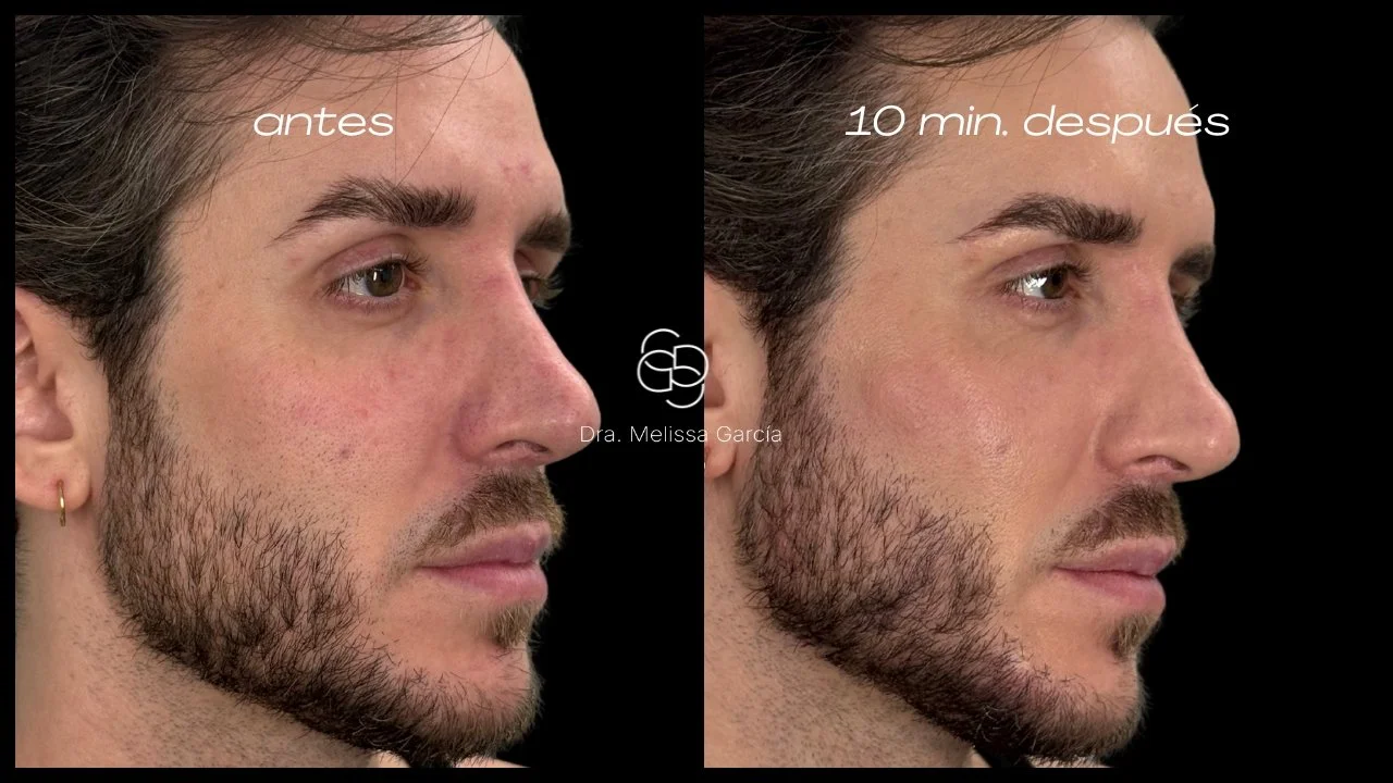 TEOXANE® BabyGLOW