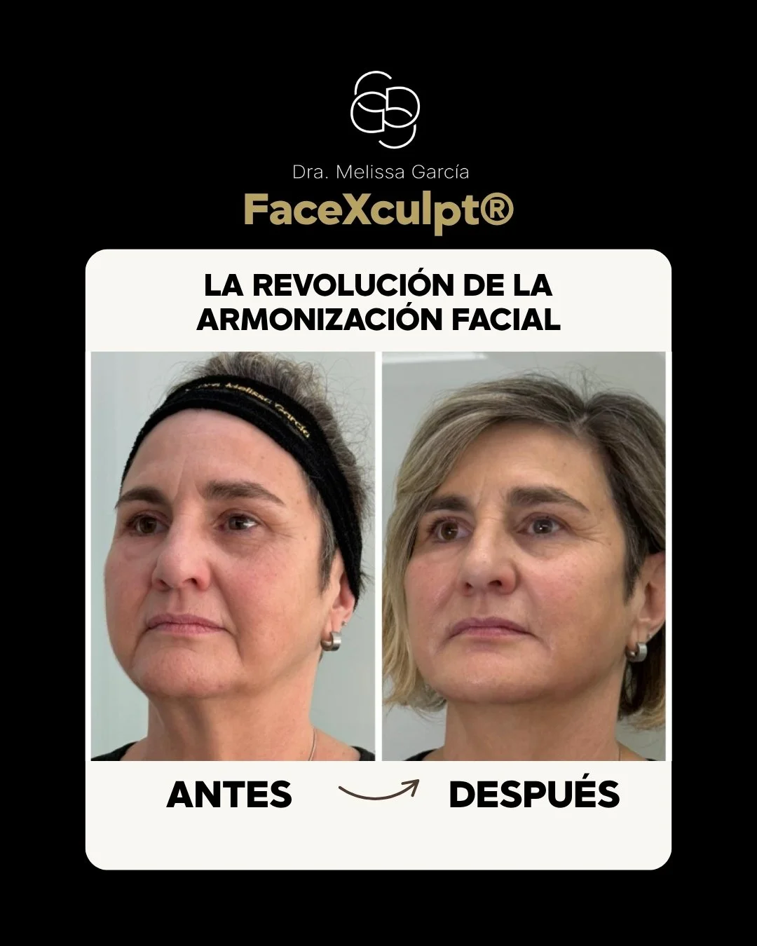 Armonización facial en Barcelona Full Face
