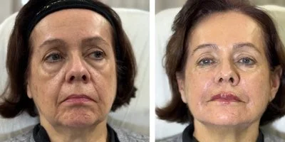 ARMONIZACIÓN FACIAL BARCELONA