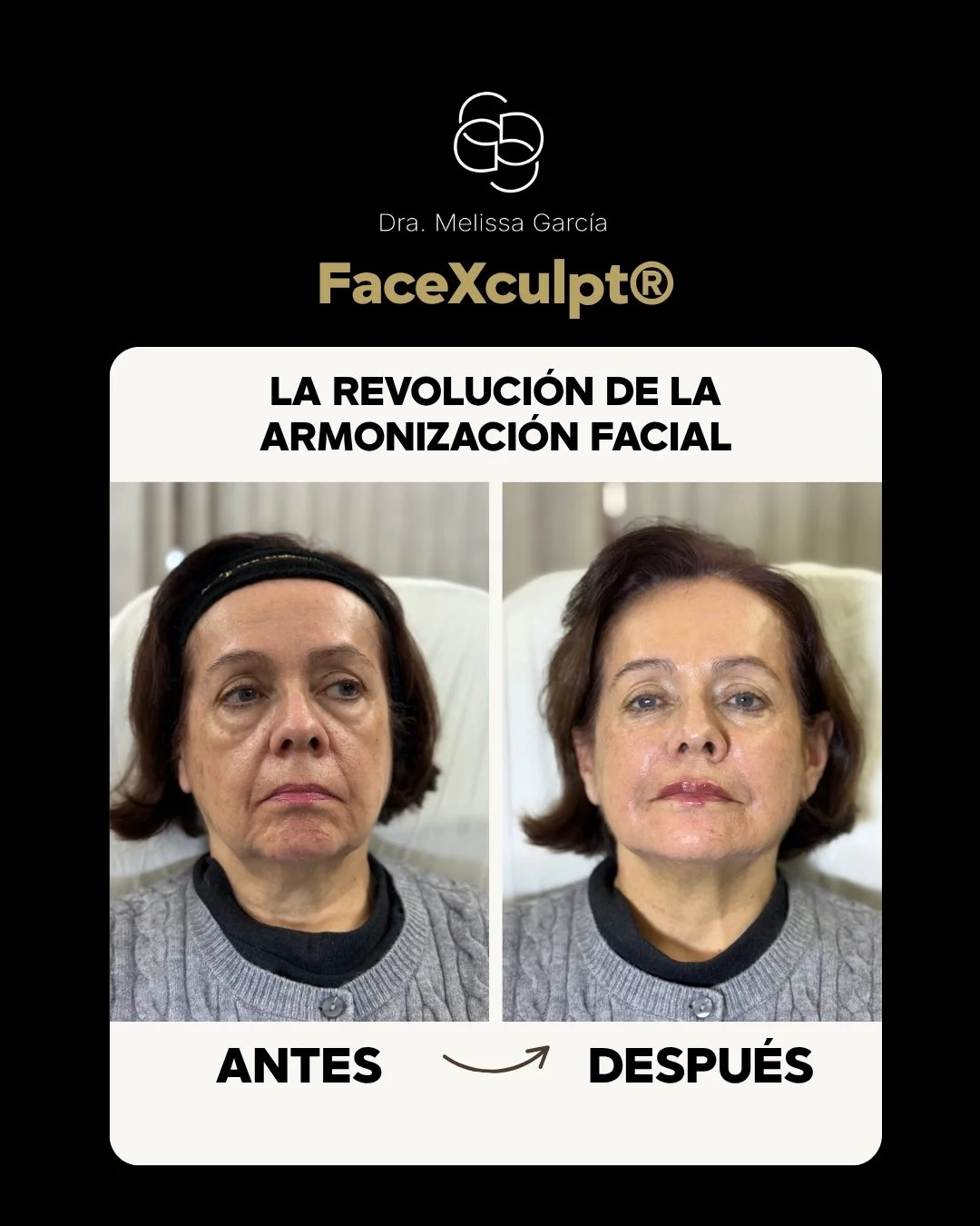 Armonización facial en Barcelona Full Face