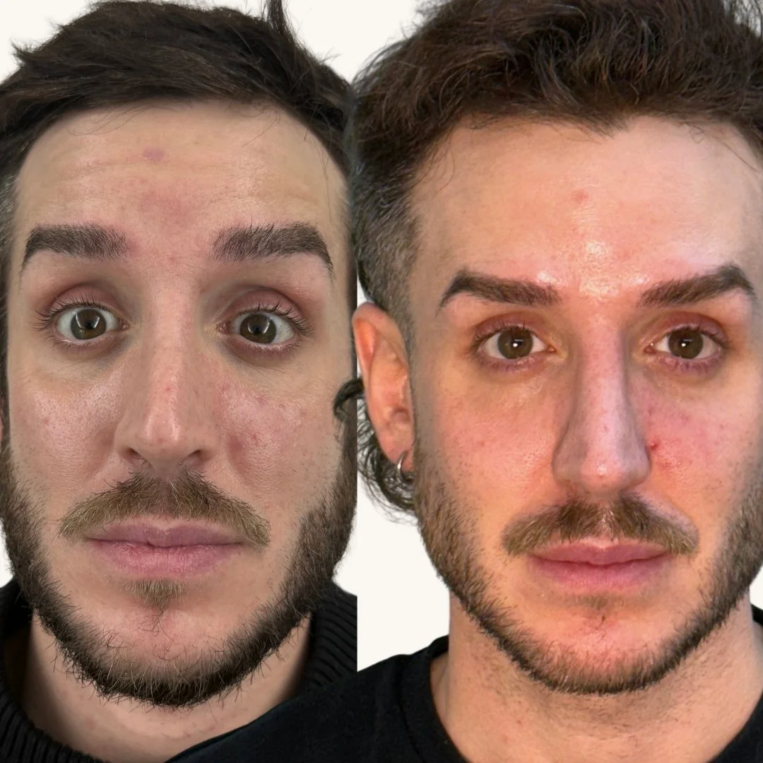 eliminar arrugas barcelona medicina estetica dra melissa garcia