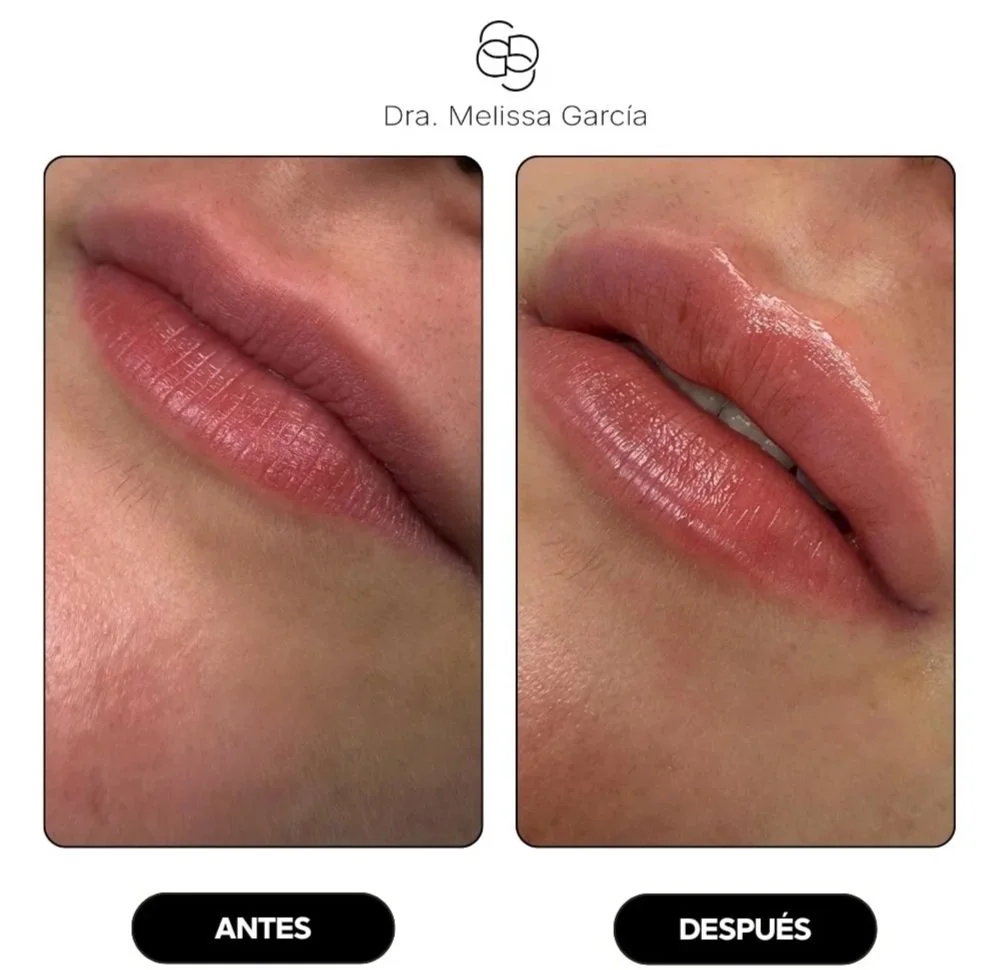 AUMENTO DE LABIOS BARCELONA
