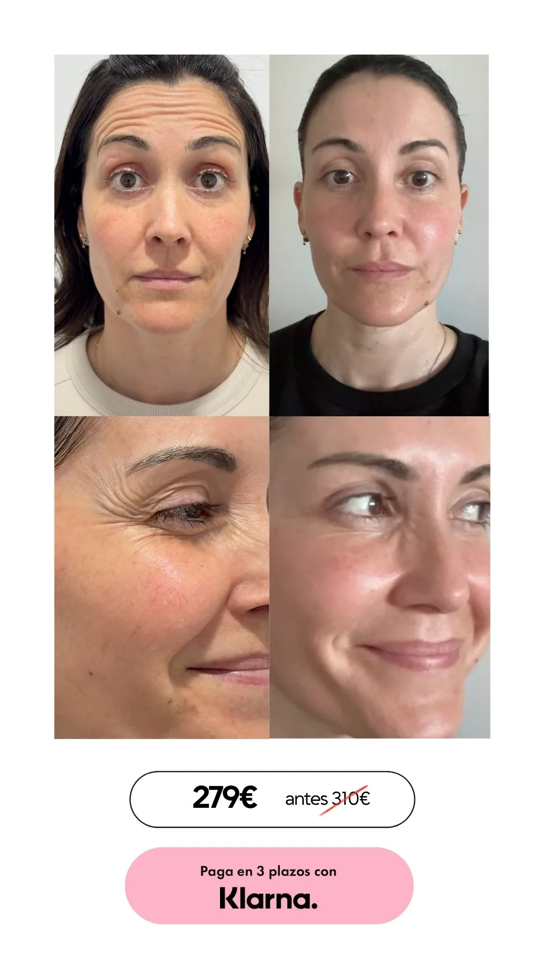 botox barcelona