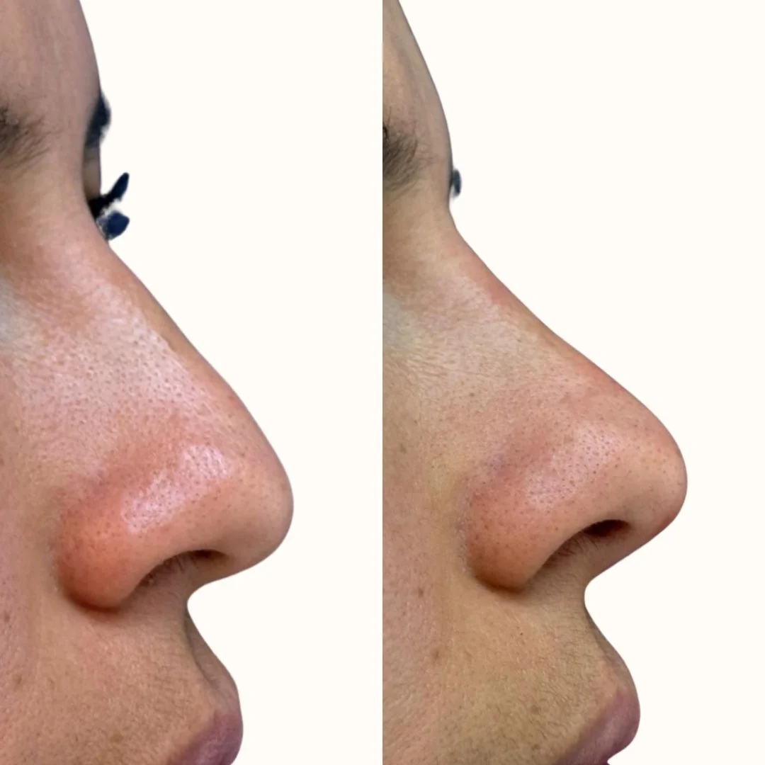 Rinomodelación con ácido hialurónico