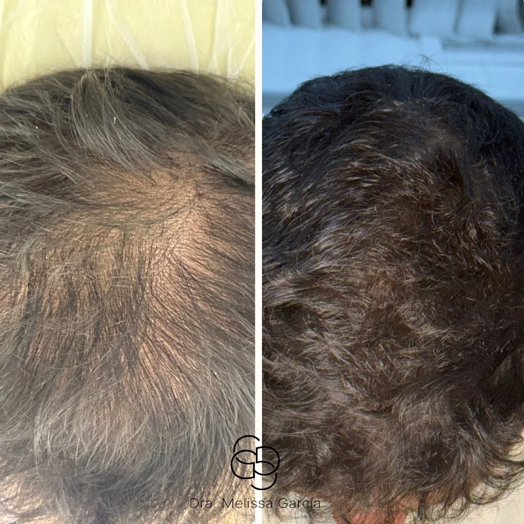 mesoterapia capilar barcelona