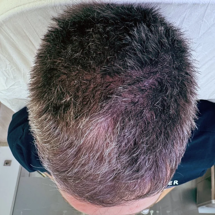 Antes tratamiento capilar