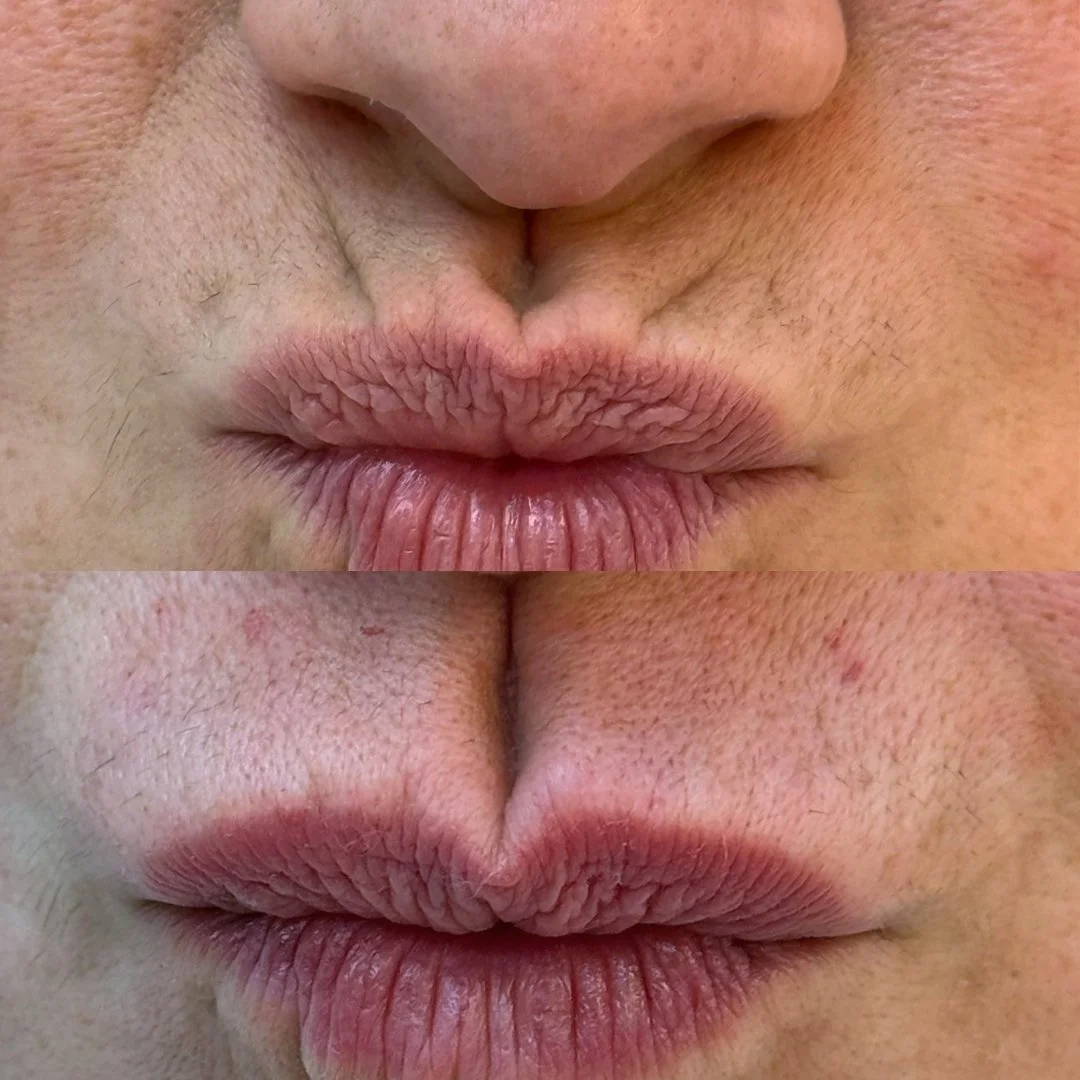 eliminar codigo de barras medicina estética barcelona