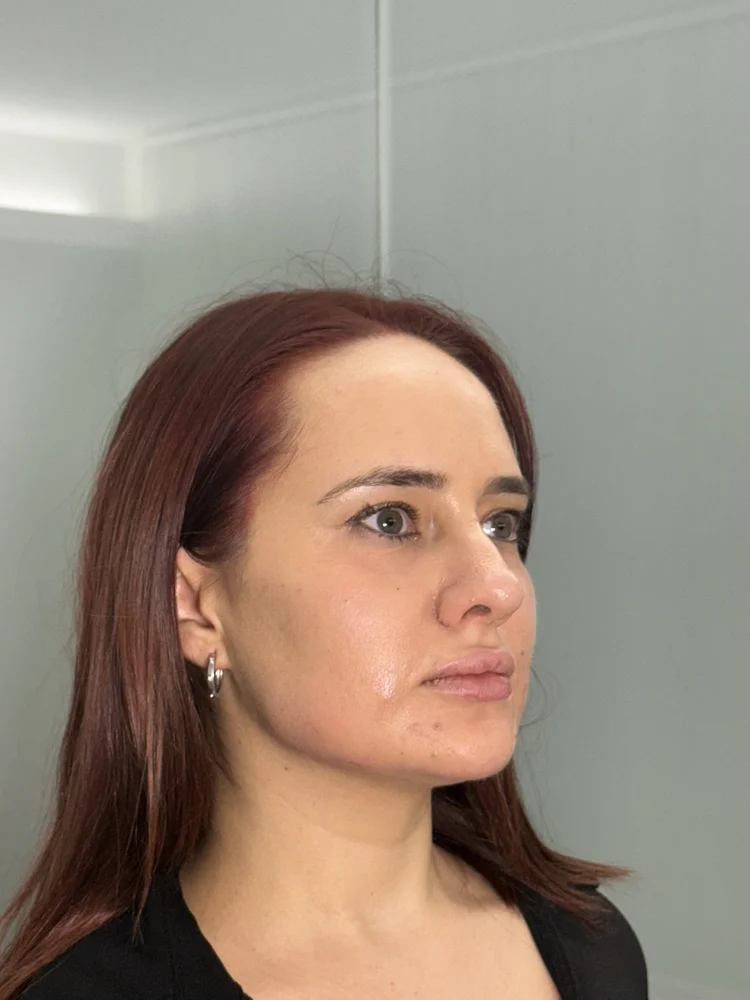 Después tratamiento facial