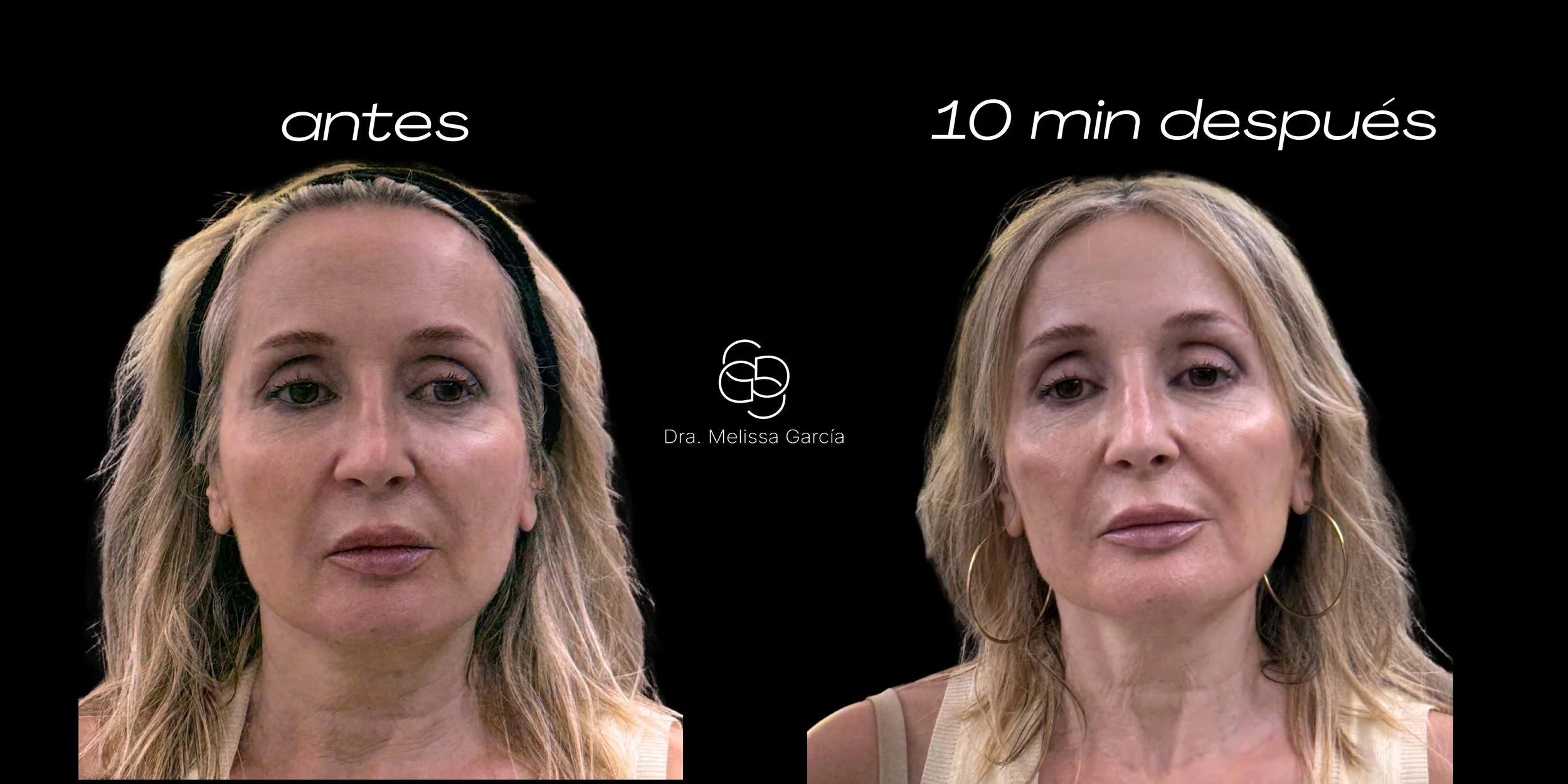 tratamiento glow barcelona
