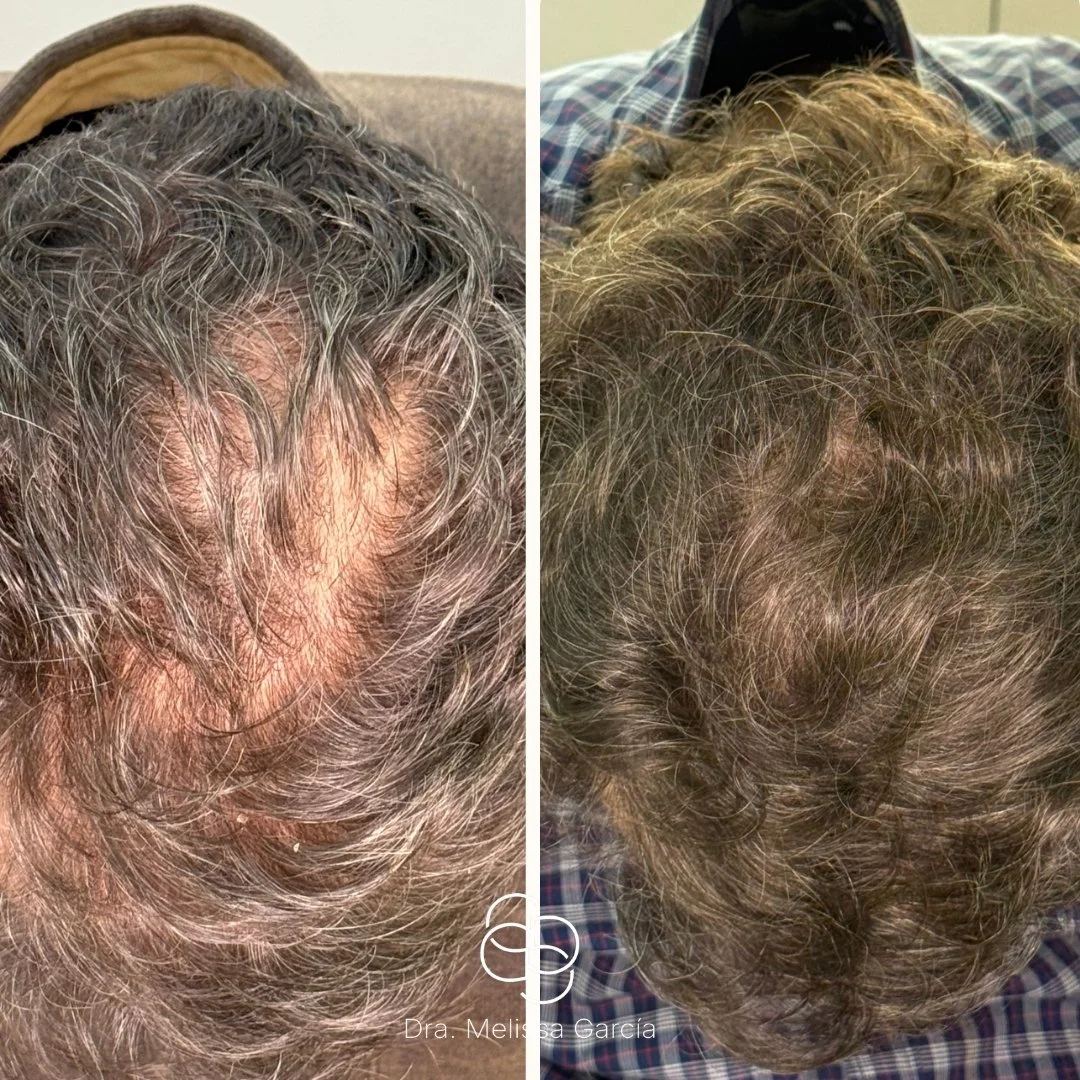 mesoterapia capilar barcelona