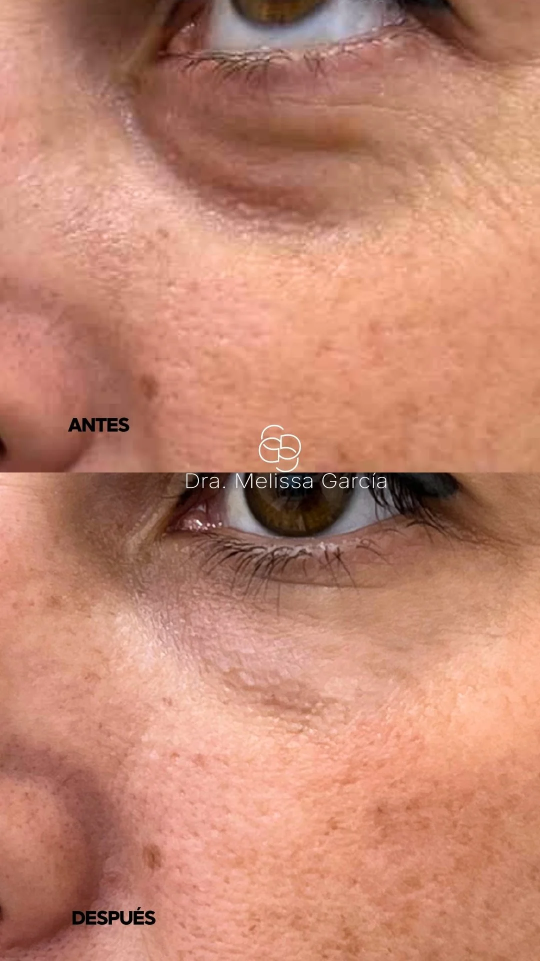 Ojeras con ácido hialurónico en Barcelona