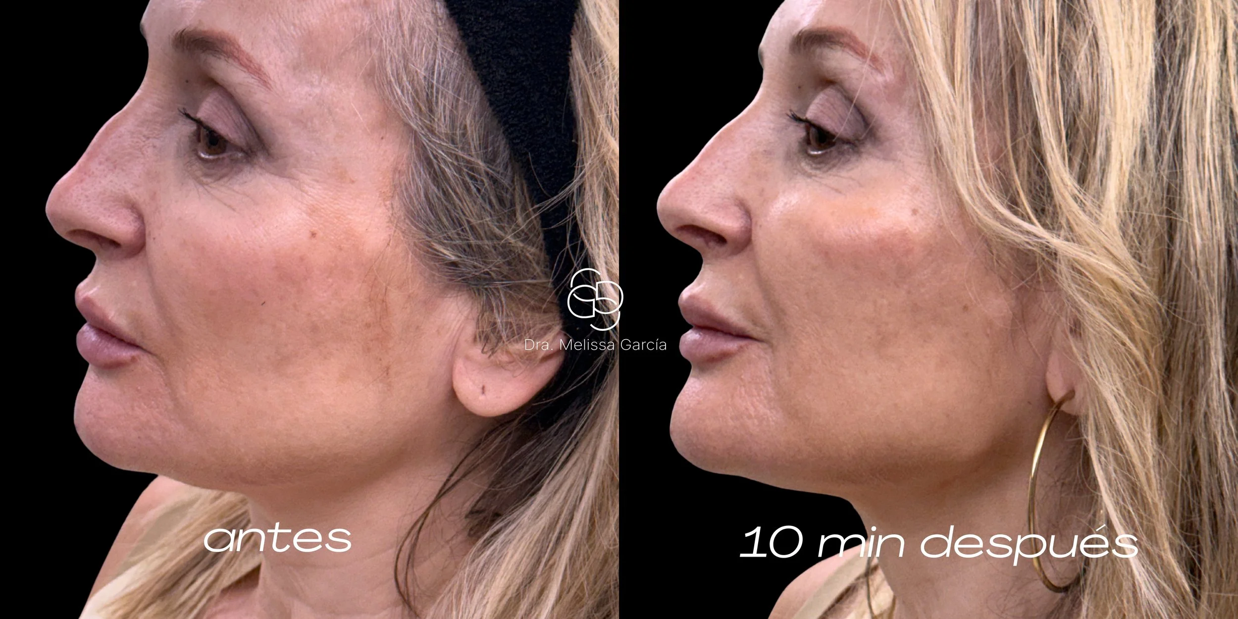 tratamiento glow barcelona