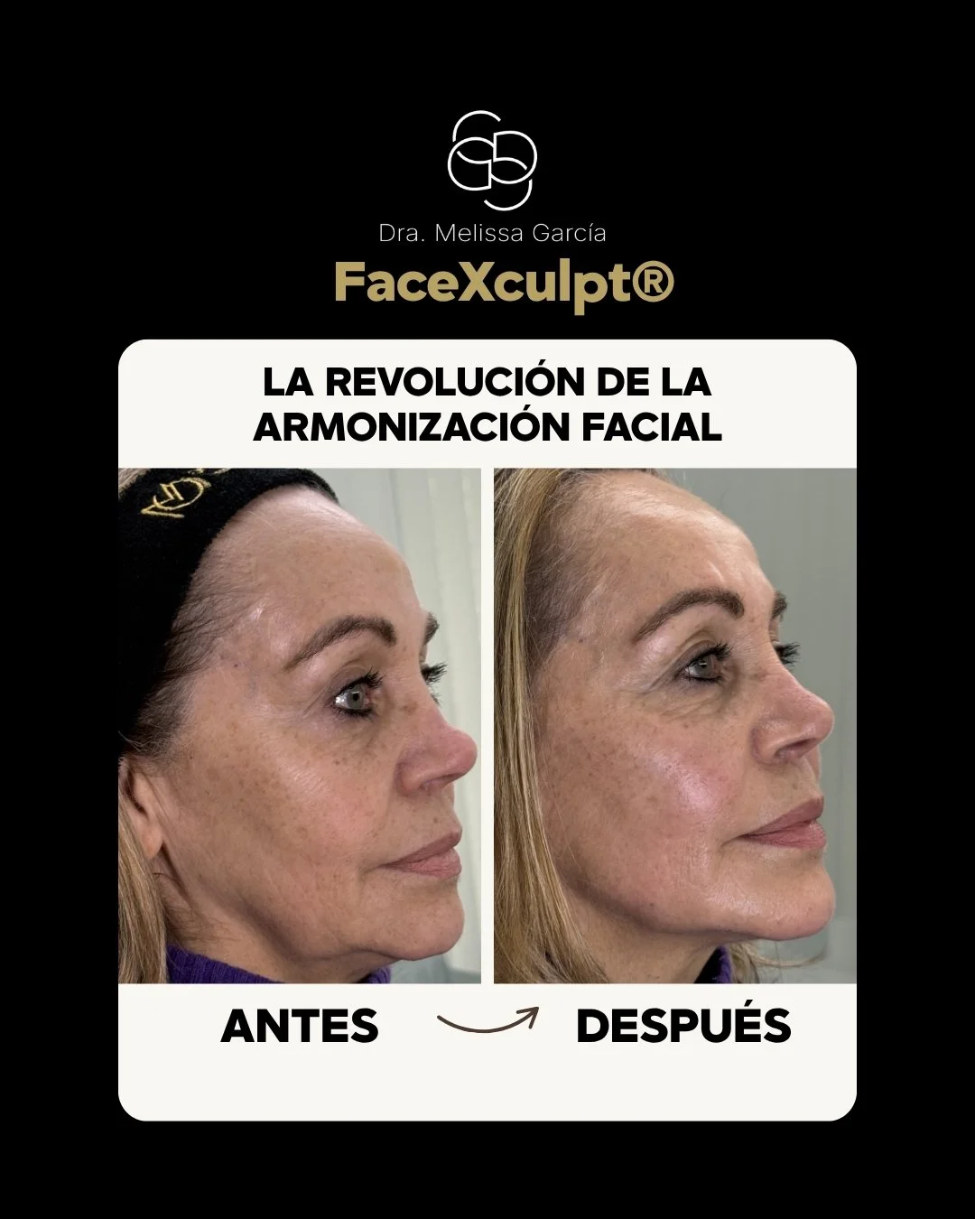 armonización facial Barcelona dra melissa garcía